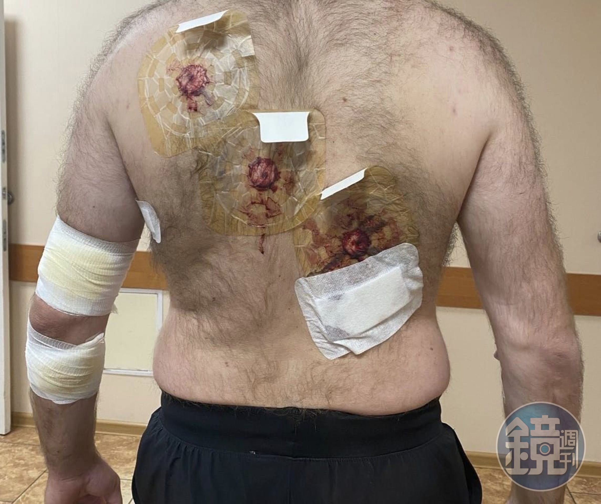陳晞與隊友遭潘男設局被手榴彈攻擊，隊友受傷險喪命。（翻攝陳晞臉書）