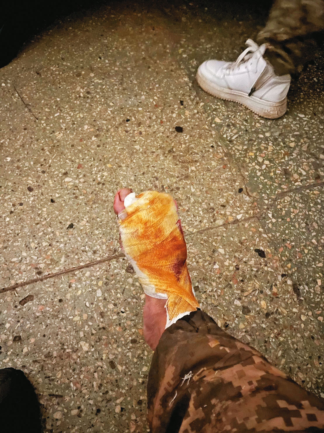 去年11月,在一場俄軍的攻擊中,Cai的腳掌遭砲彈破片貫穿,失去2隻腳趾。圖為他做完截肢手術後,紗布層層包裹的腳掌。(Cai提供)