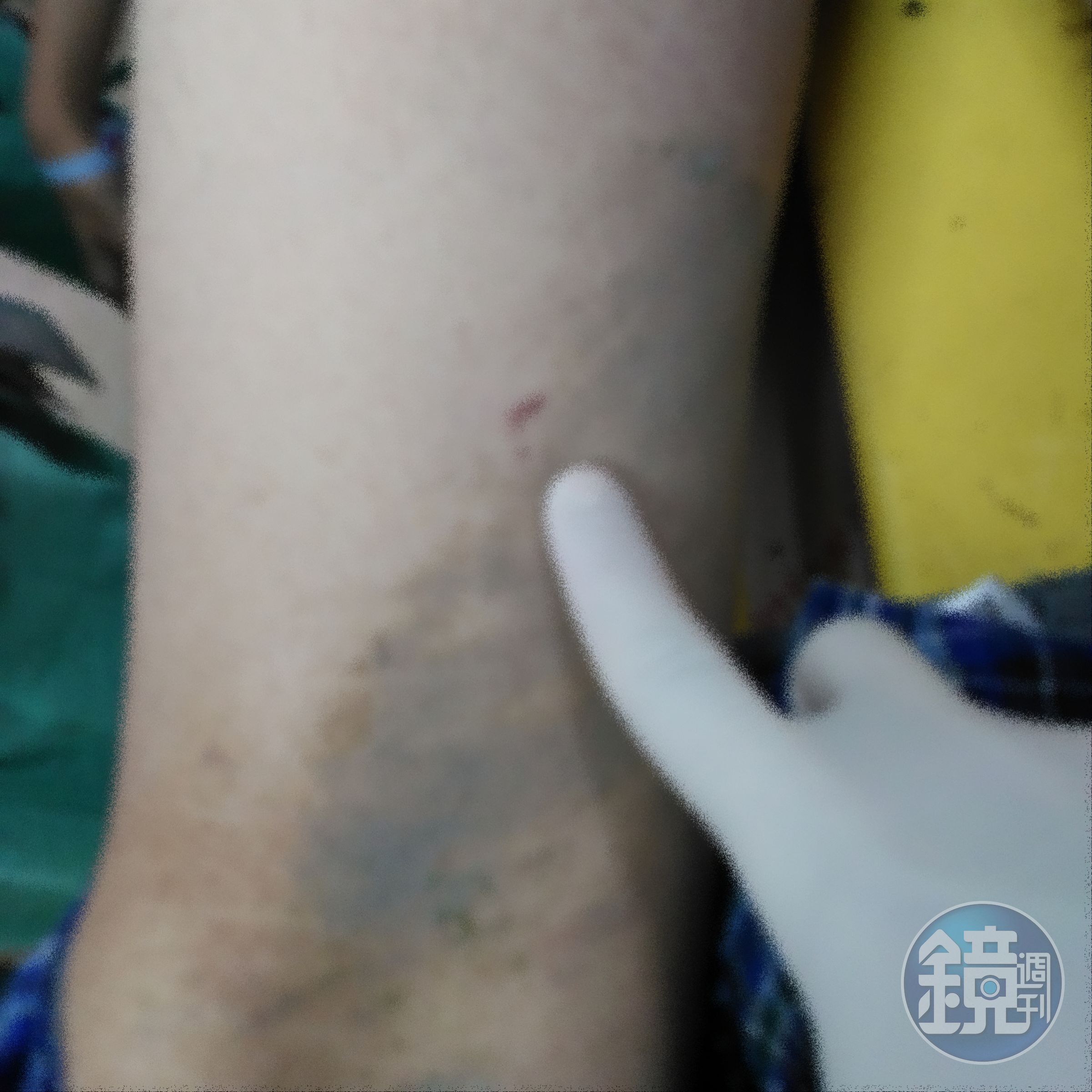 賴生手臂有不明傷痕。(家屬提供)