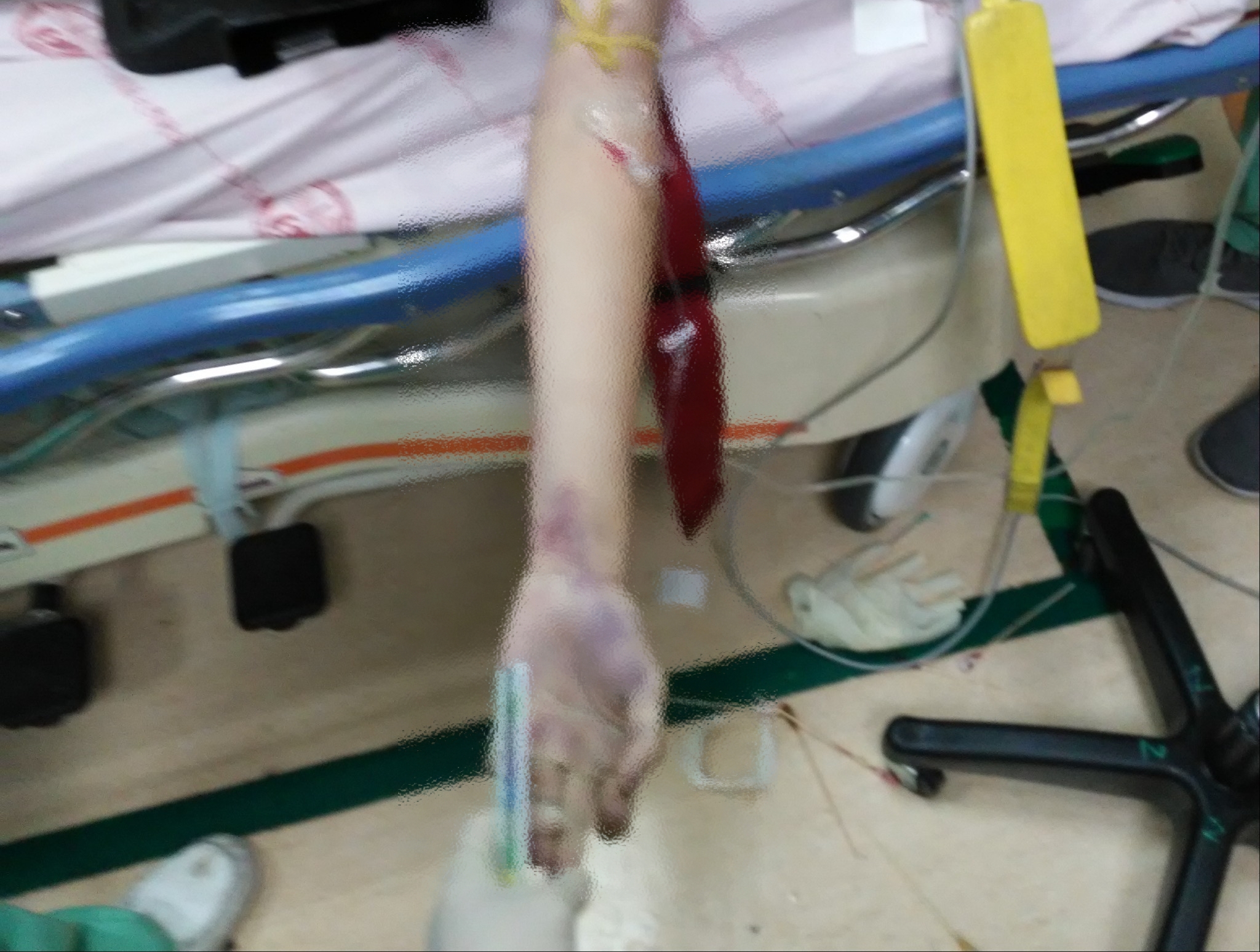 賴生在急診室，只有左手臂插管治療。（家屬提供）