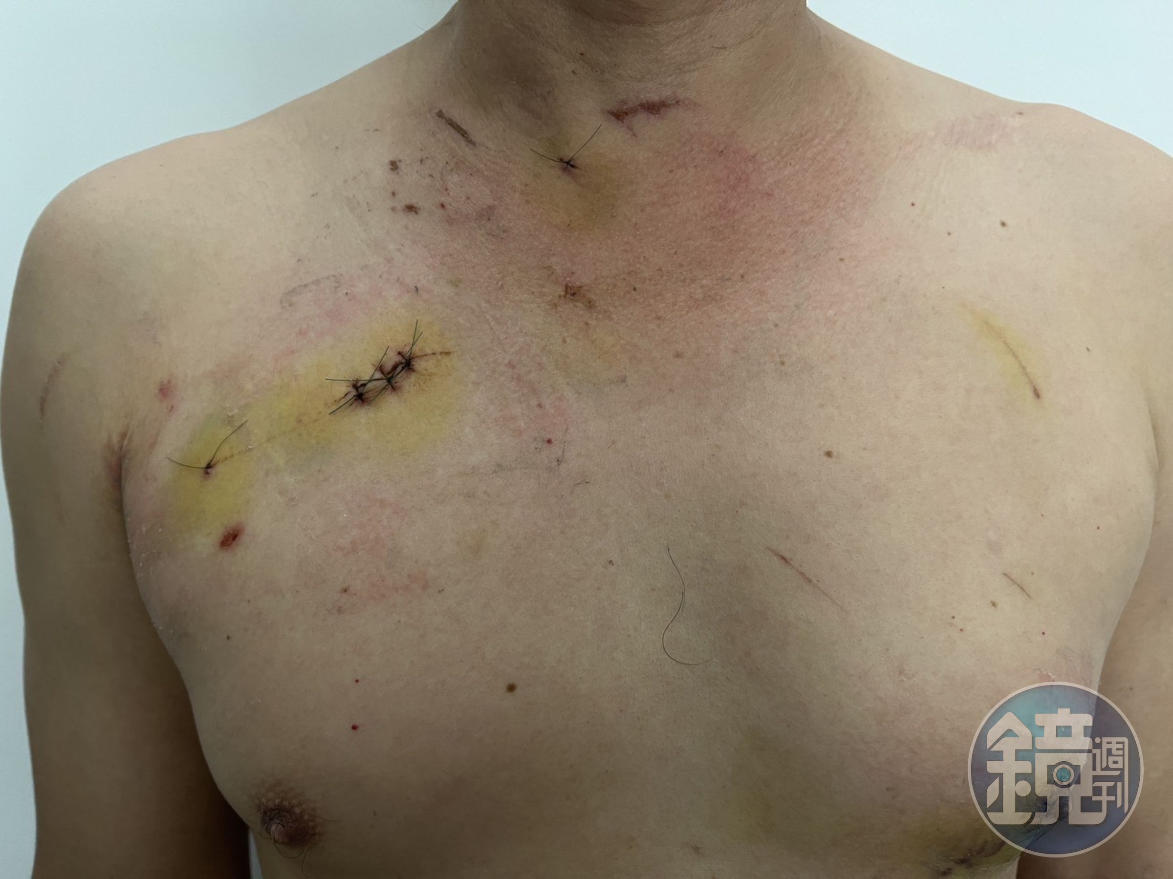 受害華男左右胸和頸部都被刺傷,險些丟了性命。(讀者提供)