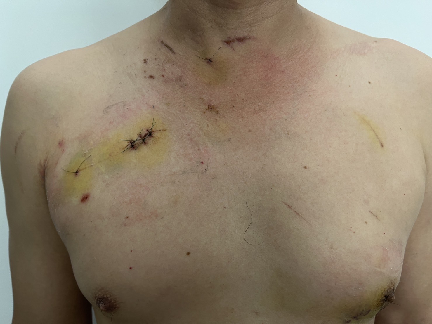 受害華男左右胸和頸部都被刺傷，險些丟了性命。（讀者提供）