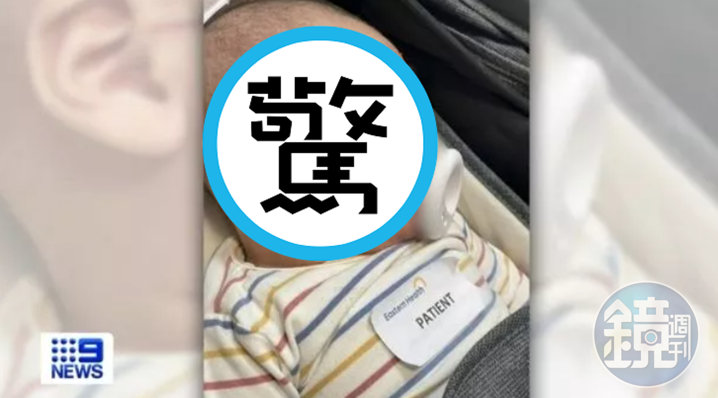 慎入!女嬰「全臉20道血刮痕」嚴重破相,育嬰中心僅稱被男童抓到臉。(翻自《9 NEWS》)