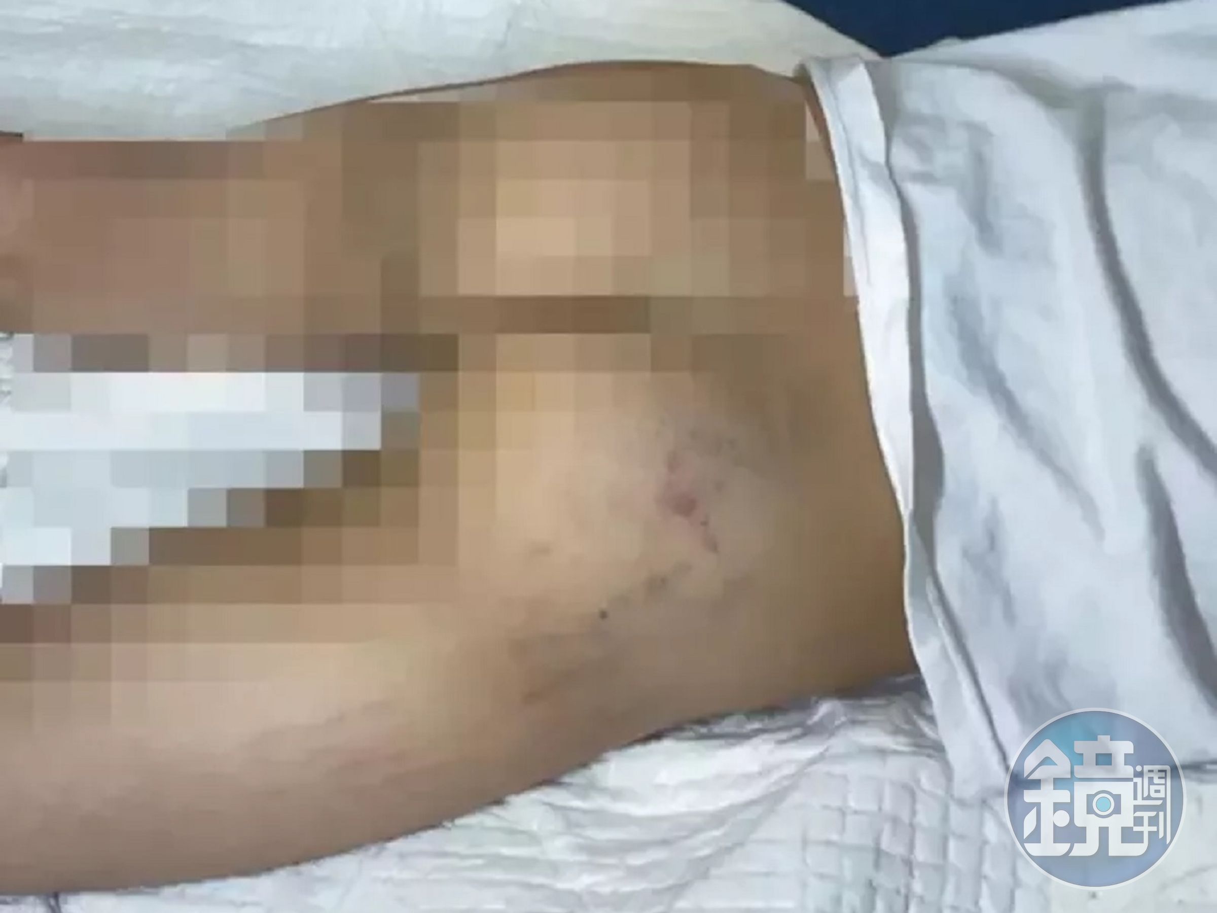 高雄鳳山一所幼兒園去年發生幼教師不當管教，將幼童臀部打成大片瘀傷。（翻攝畫面）