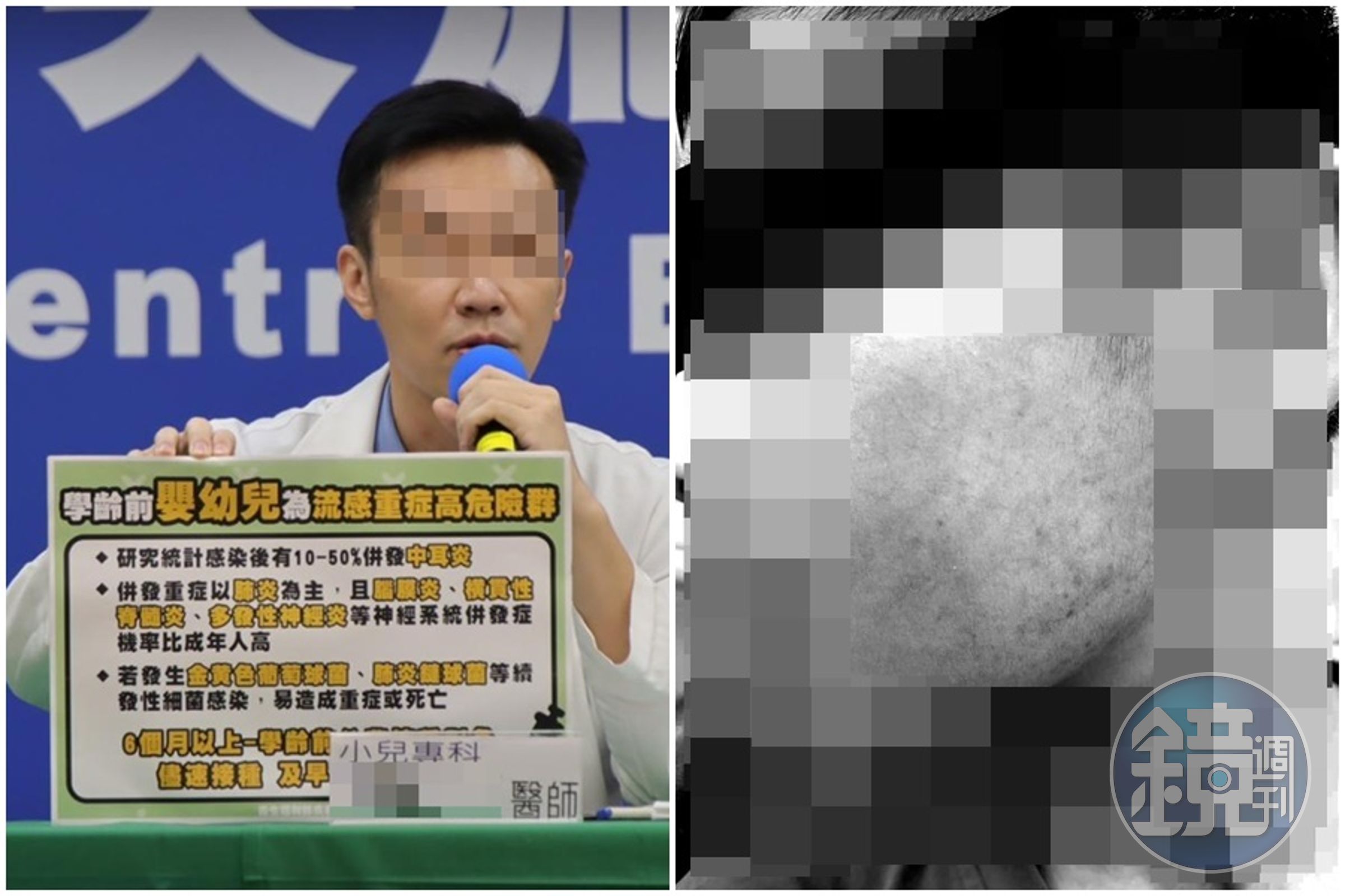曾上疫情記者會的網紅兒科醫師（左）狠甩兒子50多下巴掌，生母曝光孩童傷勢照（右）。（左圖指揮中心提供，右圖翻攝自嘎老師Miss Ga臉書）