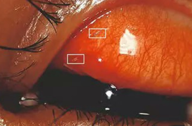 土耳其10歲男童因為眼睛痛就診，經檢查竟發現有活蛆寄生眼中。（翻攝推特@habertip）