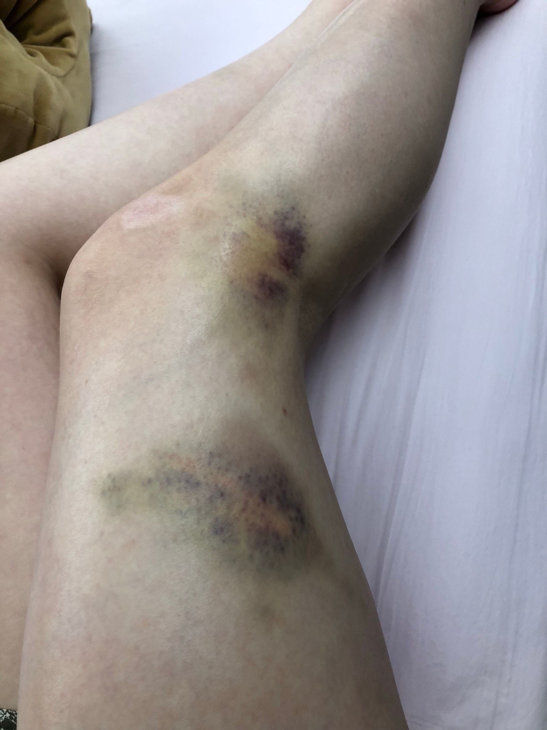 受害女腿部也有大面積傷勢。(讀者提供)