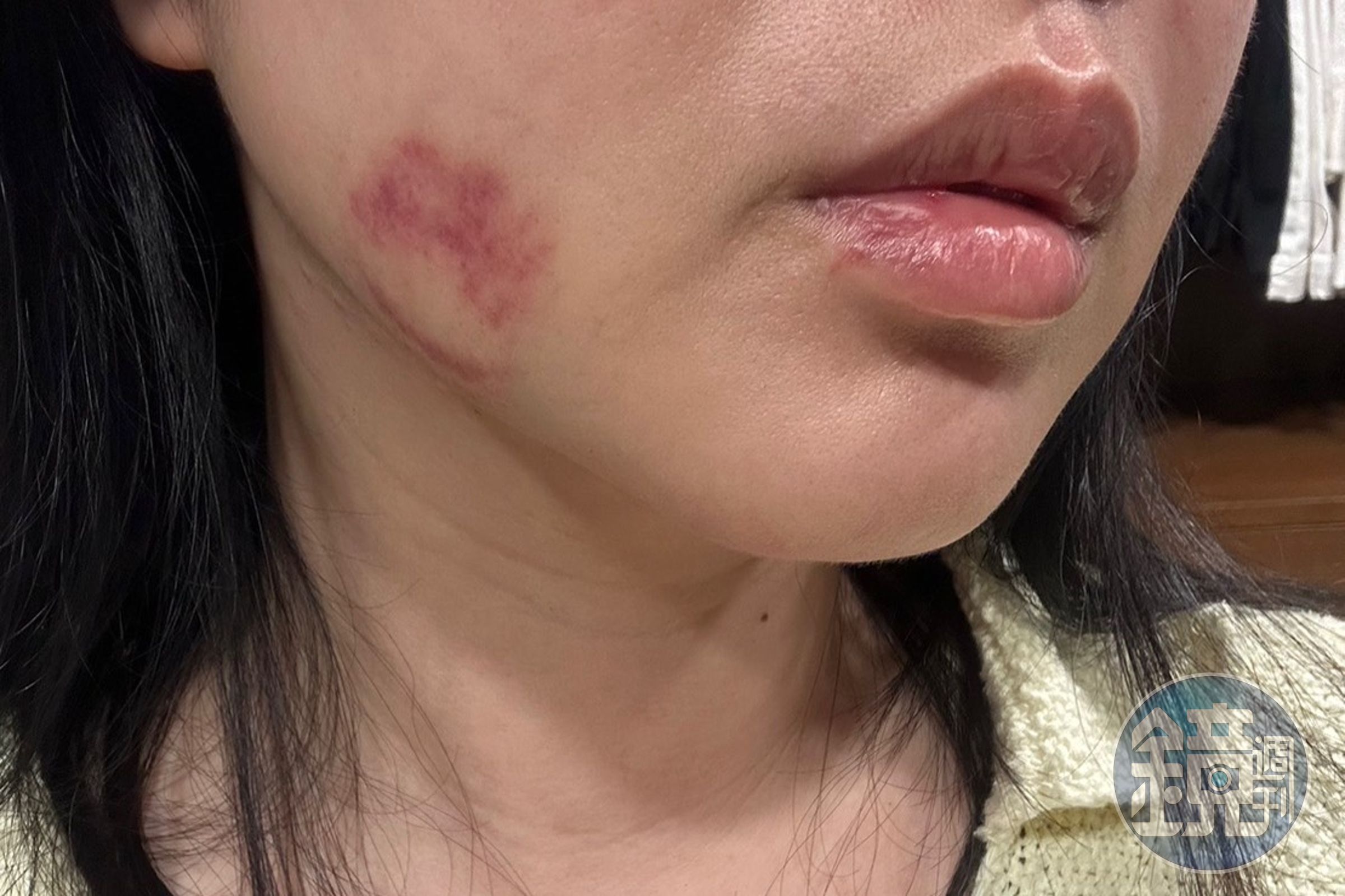 受害女被打到全身都是傷,臉部也留下明顯瘀傷。(讀者提供)