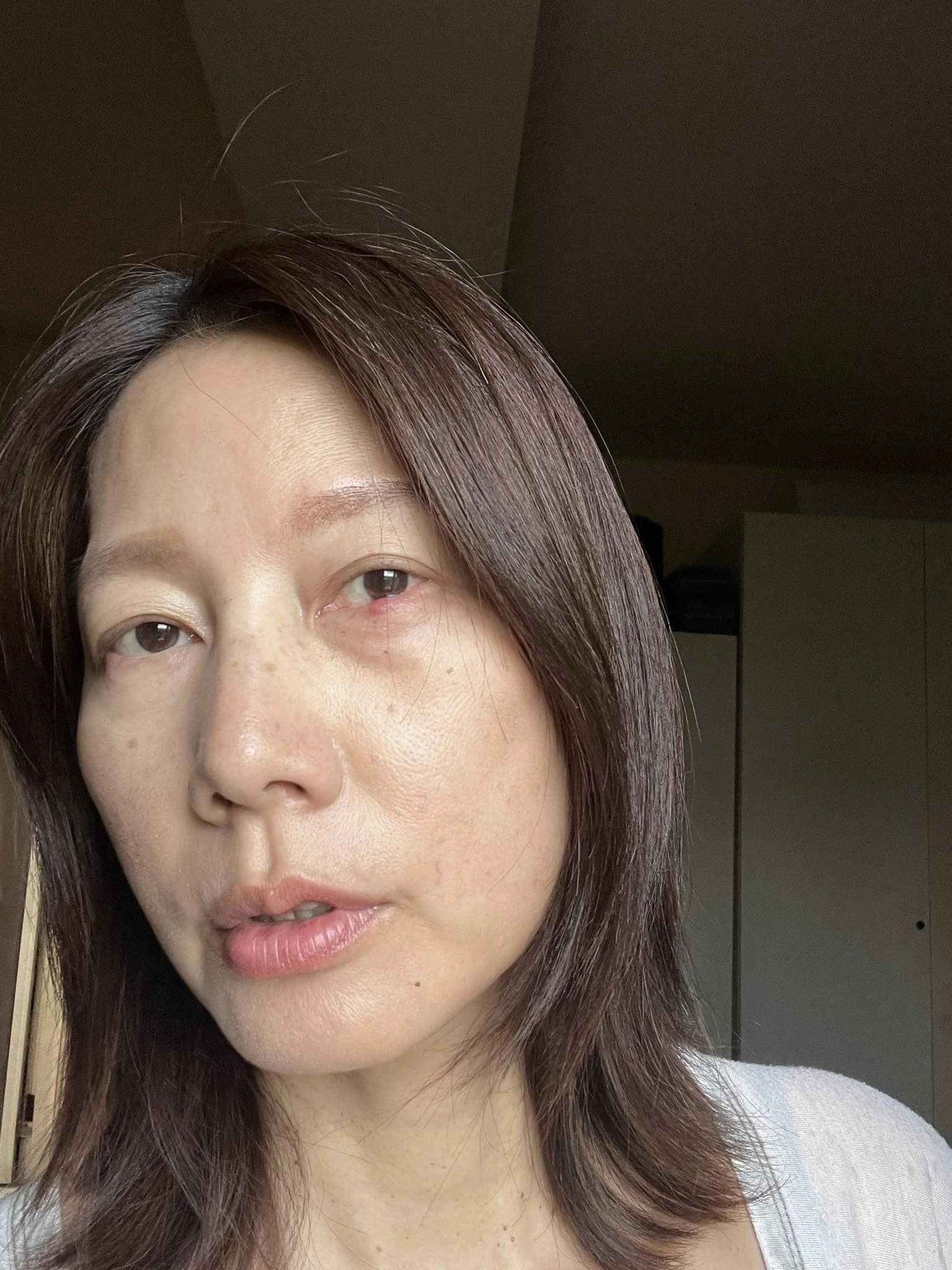 丁寧的針眼長的很大模樣駭人。（翻攝自臉書）