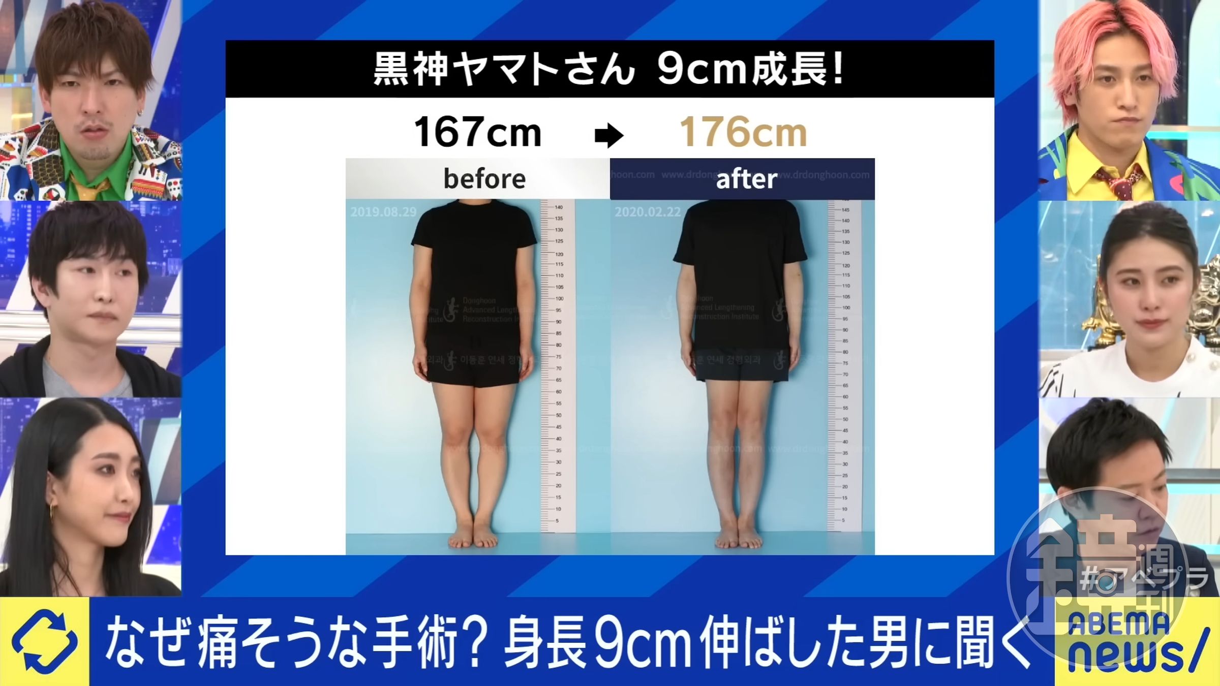 黑神YAMATO透過手術增高9公分。（翻攝自《ABEMA Prime》）