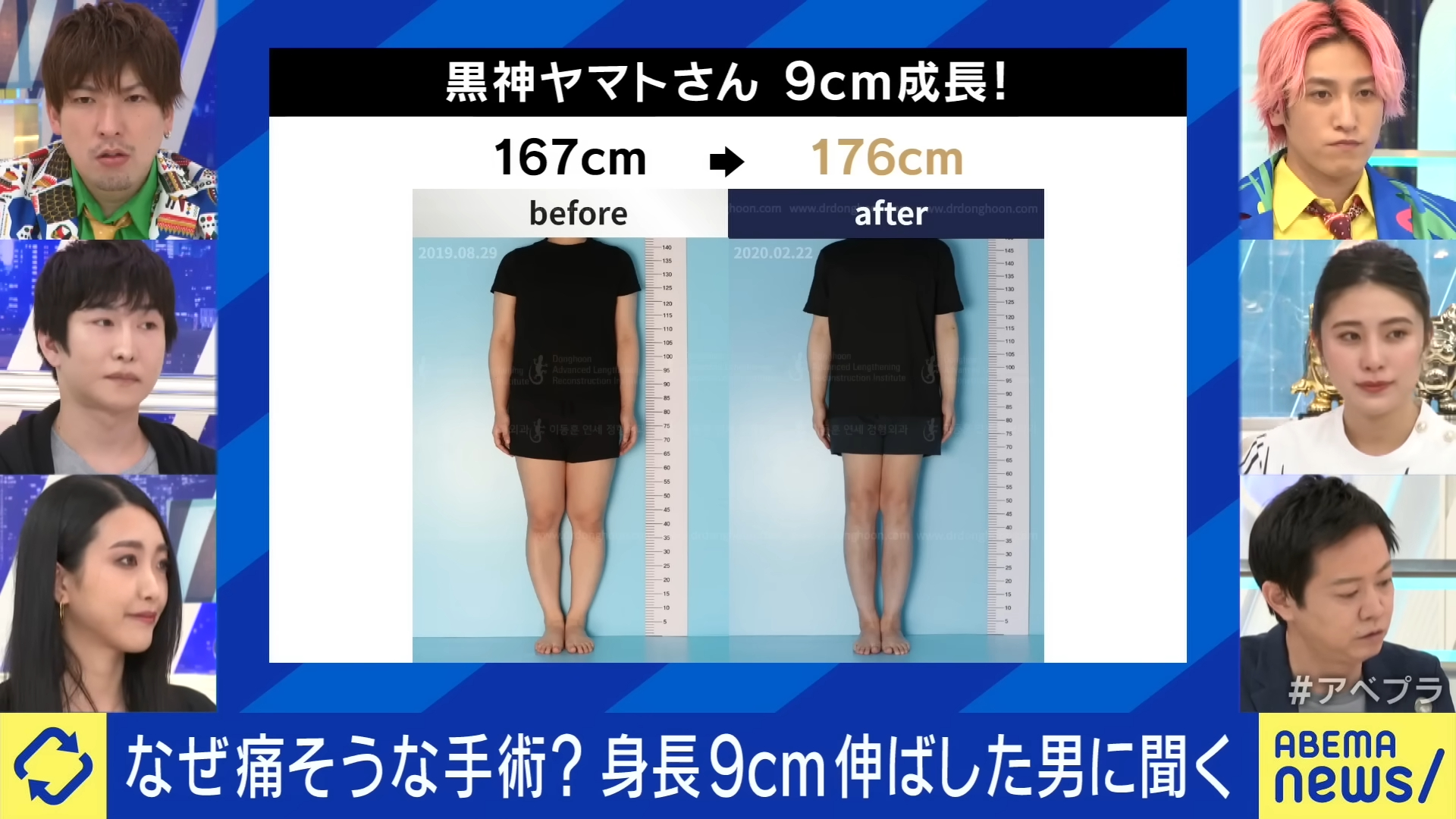 黑神YAMATO透過手術增高9公分。(翻攝自《ABEMA Prime》)