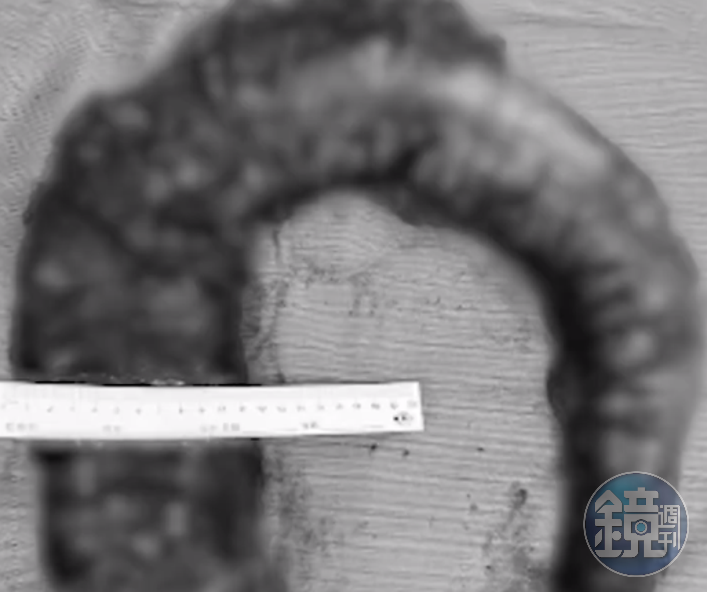 中國1名女子患有巨結腸症,醫生從她體內取出近20公斤的糞便,宛如1條大蟒蛇。(翻攝自新浪新聞)