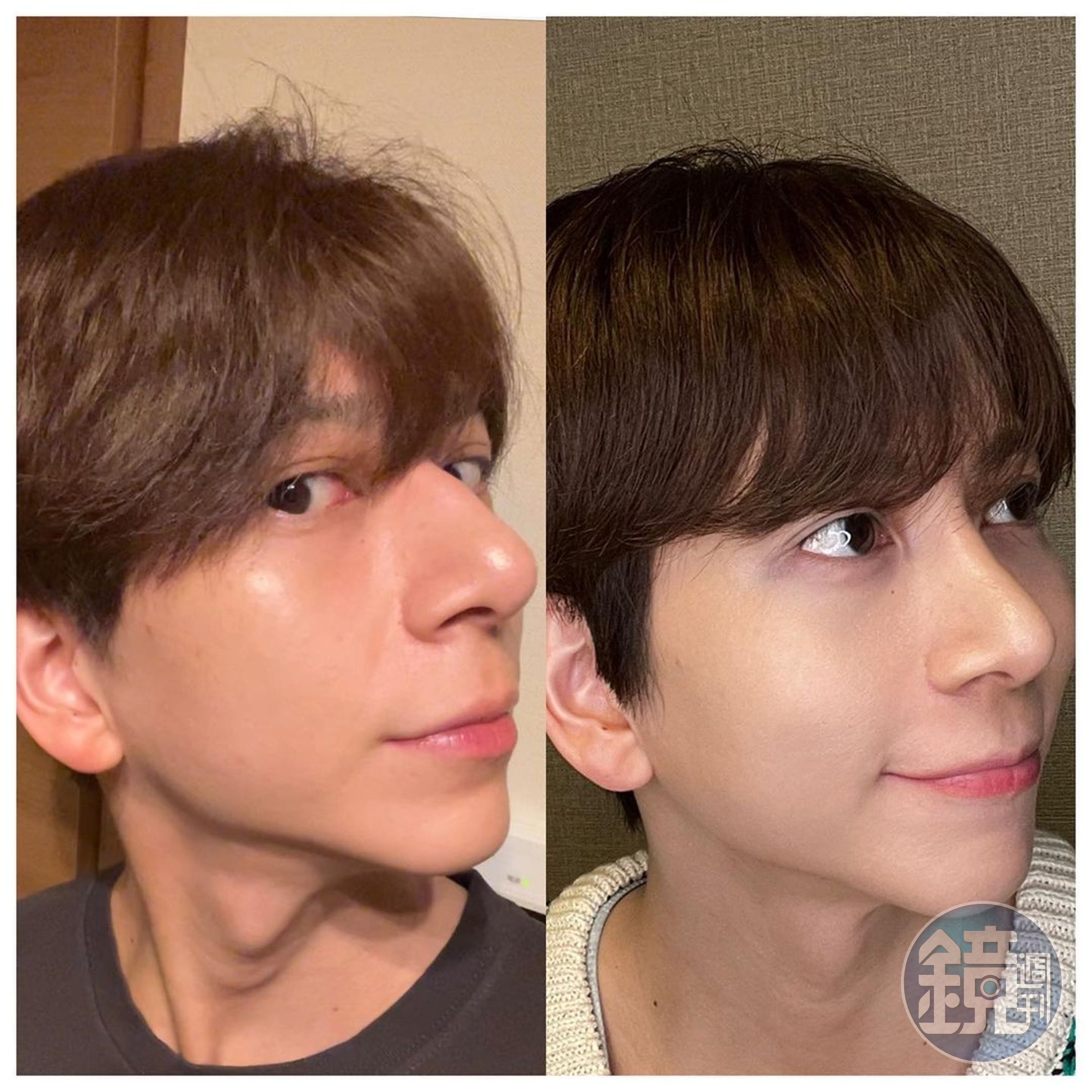 Kouhei曾大方在INS分享鼻子整型的對比圖。(翻攝Kouhei INS)