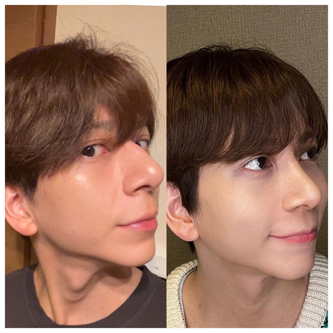Kouhei曾大方在INS分享鼻子整型的對比圖。(翻攝Kouhei INS)