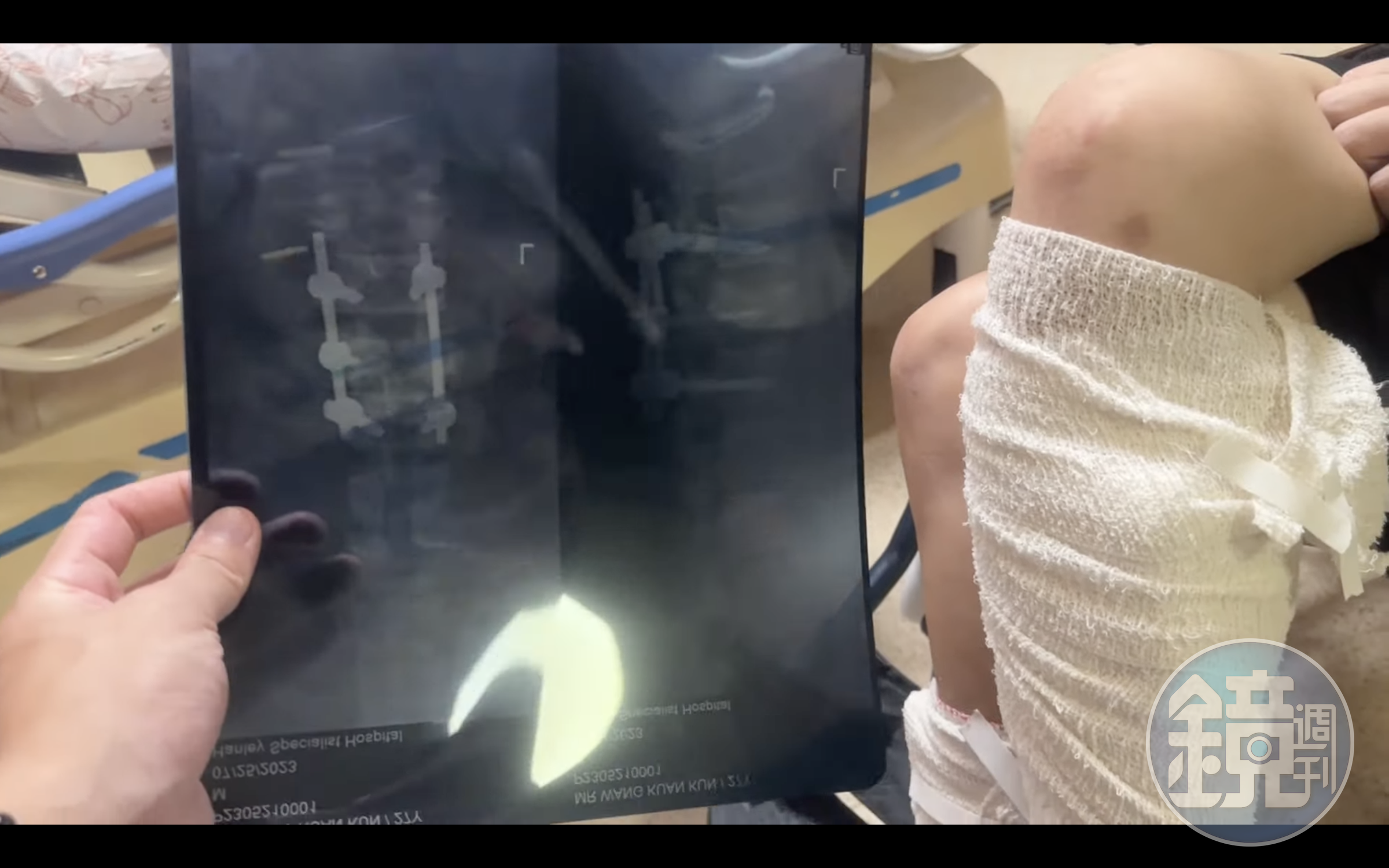 男子急迫想逃離詐騙園區,以床單當繩子想從7樓逃脫,沒想到意外重摔,造成腰椎及雙腿嚴重受損。(翻攝「全球反詐騙組織GASO-中文」YouTube)