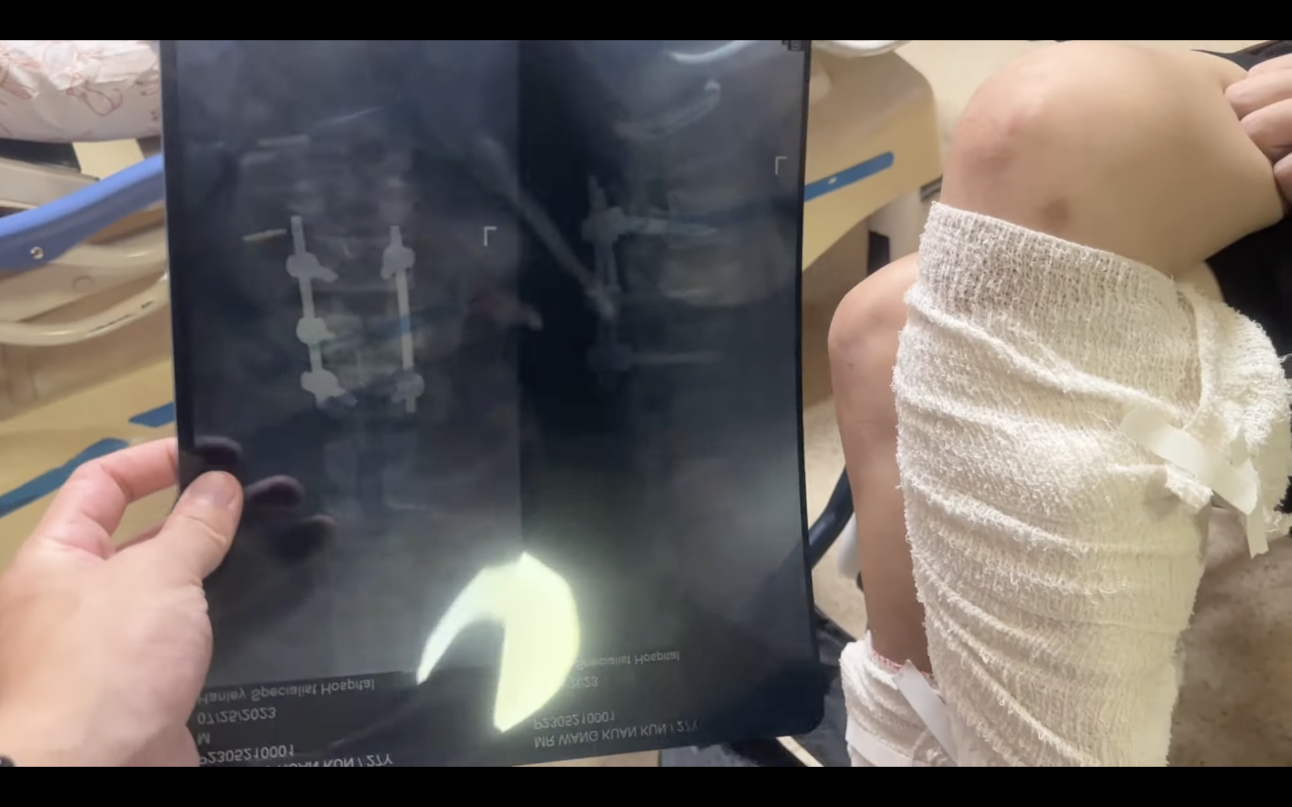 男子急迫想逃離詐騙園區，以床單當繩子想從7樓逃脫，沒想到意外重摔，造成腰椎及雙腿嚴重受損。（翻攝「全球反詐騙組織GASO-中文」YouTube）