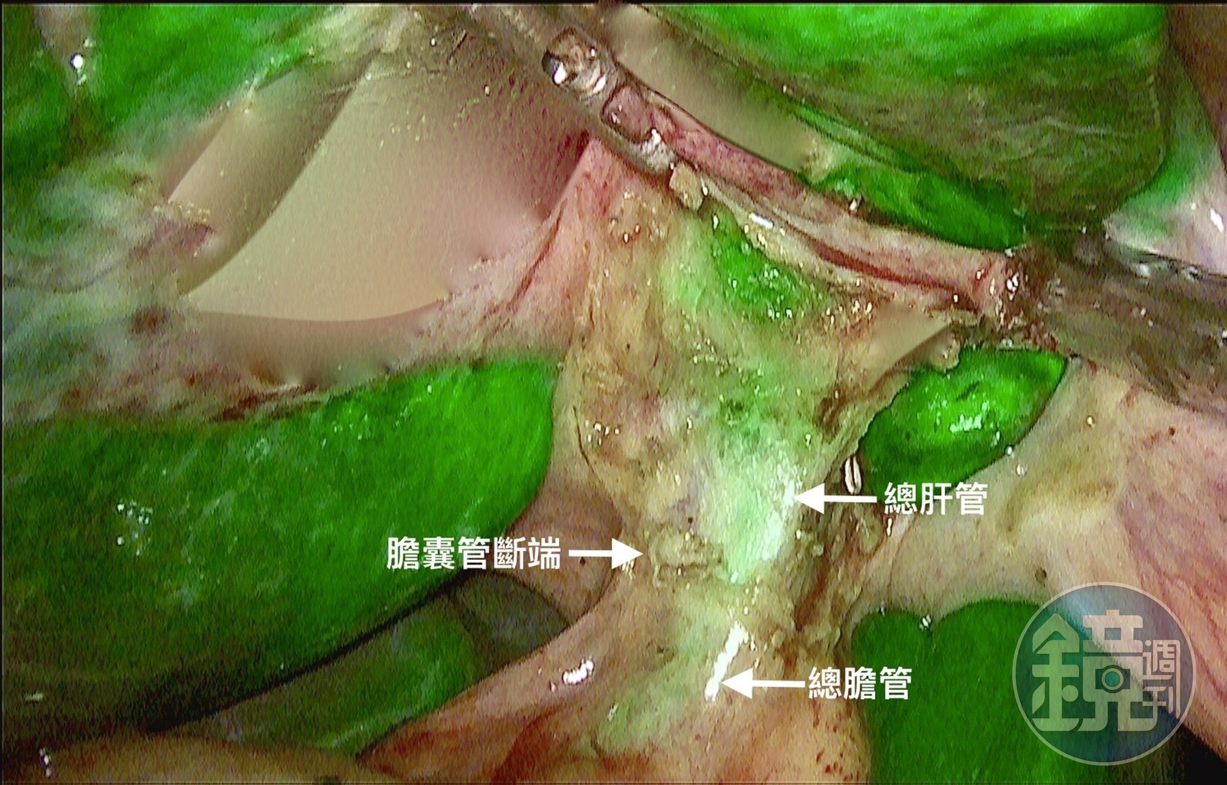 膽結石可透過腹腔鏡膽囊切除術處理。（中國醫藥大學新竹附設醫院提供）