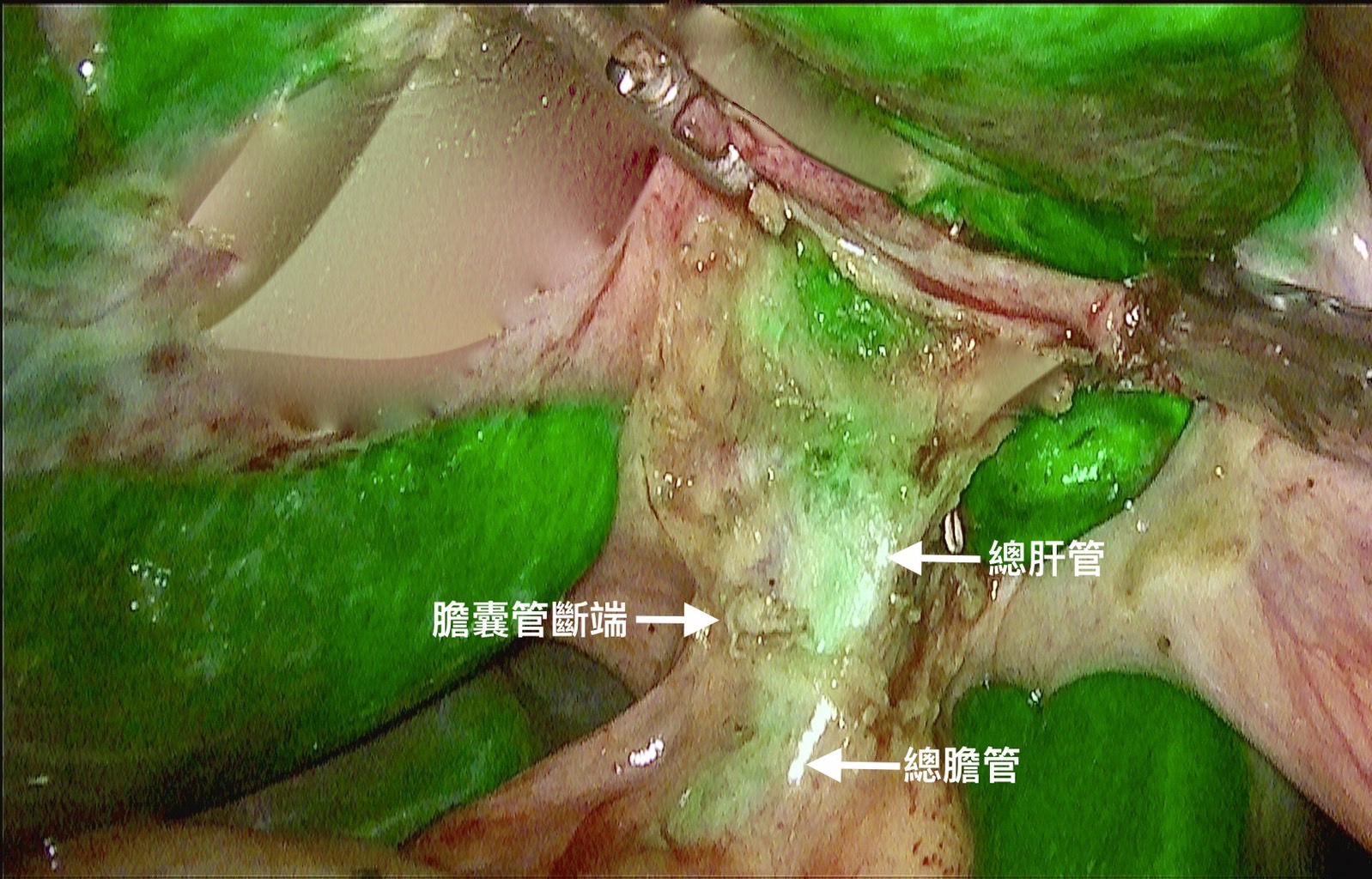 膽結石可透過腹腔鏡膽囊切除術處理。（中國醫藥大學新竹附設醫院提供）