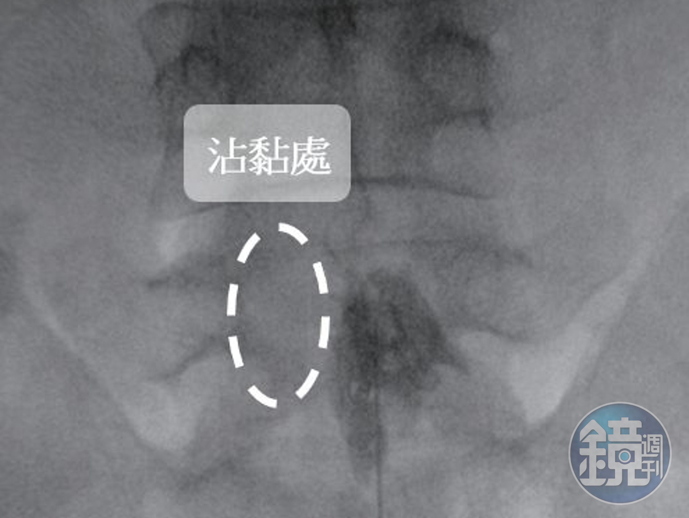 8成的成年人曾因為下背痛就醫，萬芳醫院疼痛科推「硬脊膜外神經解沾黏術」。（萬芳醫院提供）