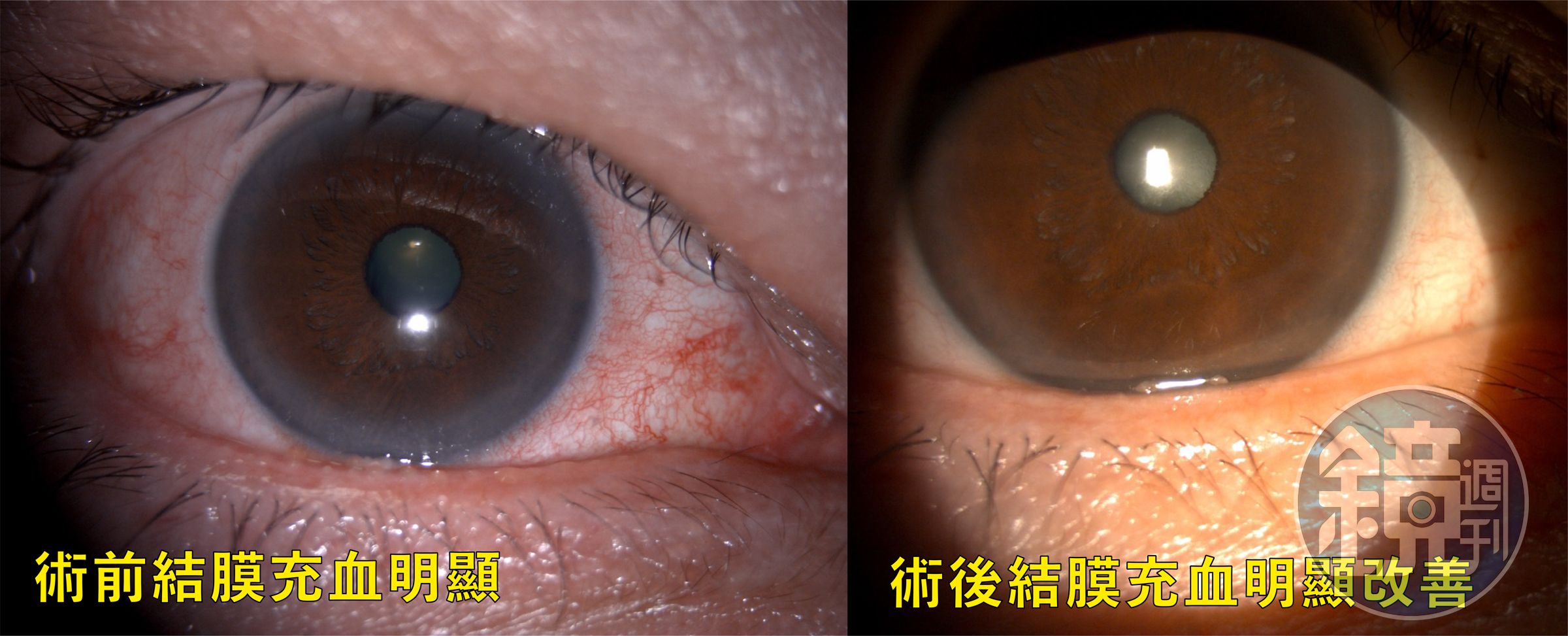 手術前結膜充血與術後改善比較。（中國醫藥大學新竹附設醫院提供）