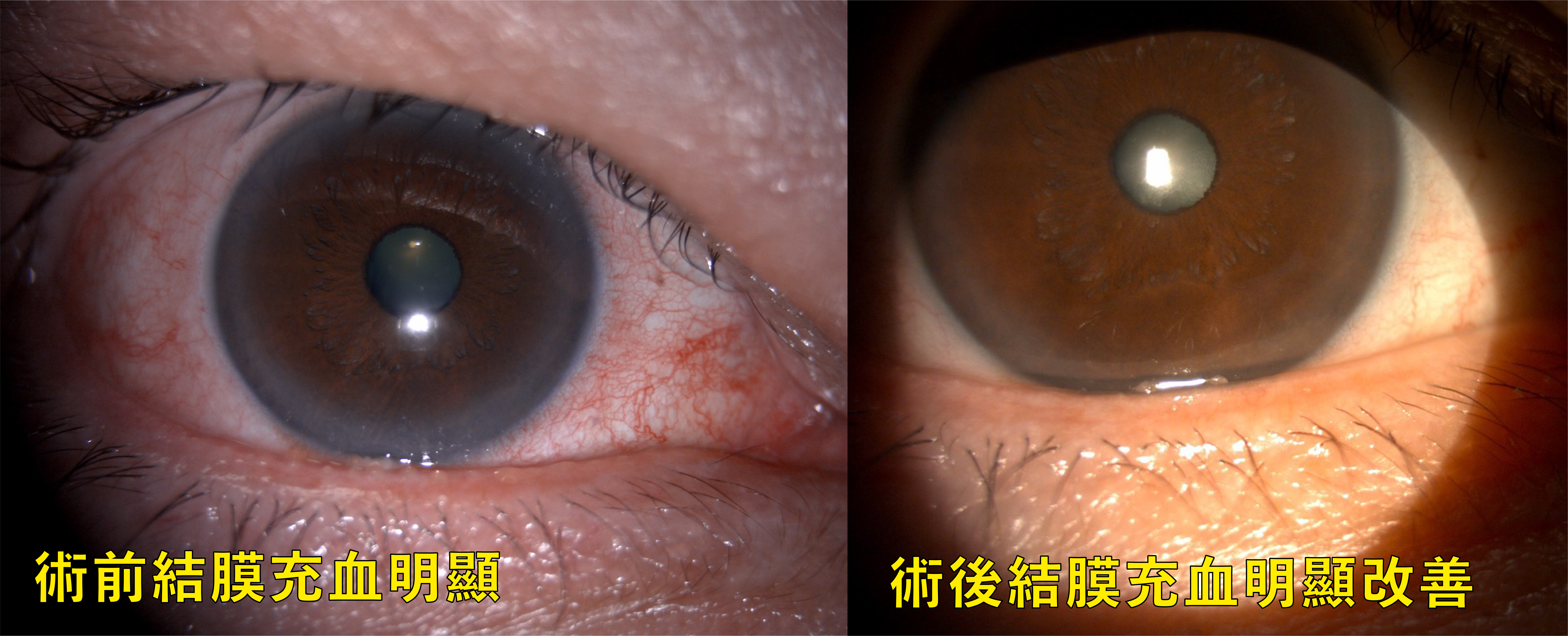 手術前結膜充血與術後改善比較。（中國醫藥大學新竹附設醫院提供）