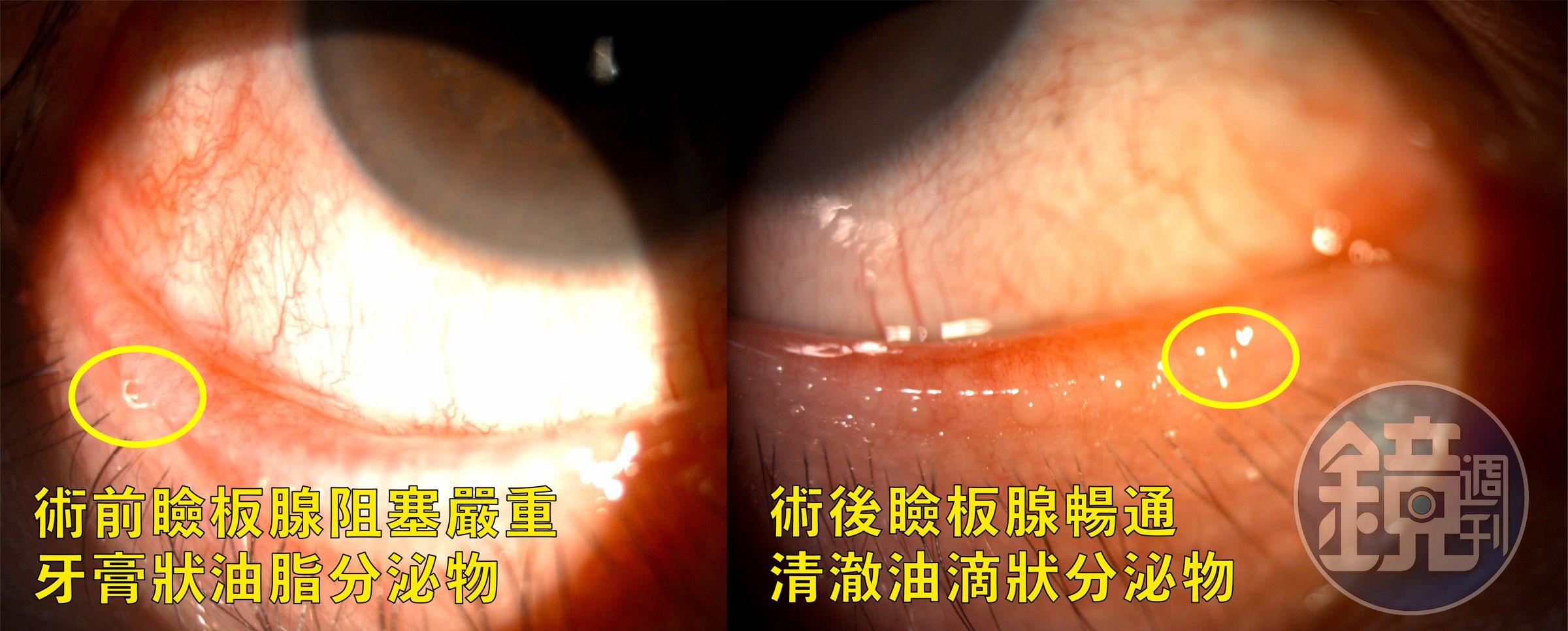 手術前眼板腺與術後改善比較。（中國醫藥大學新竹附設醫院提供）