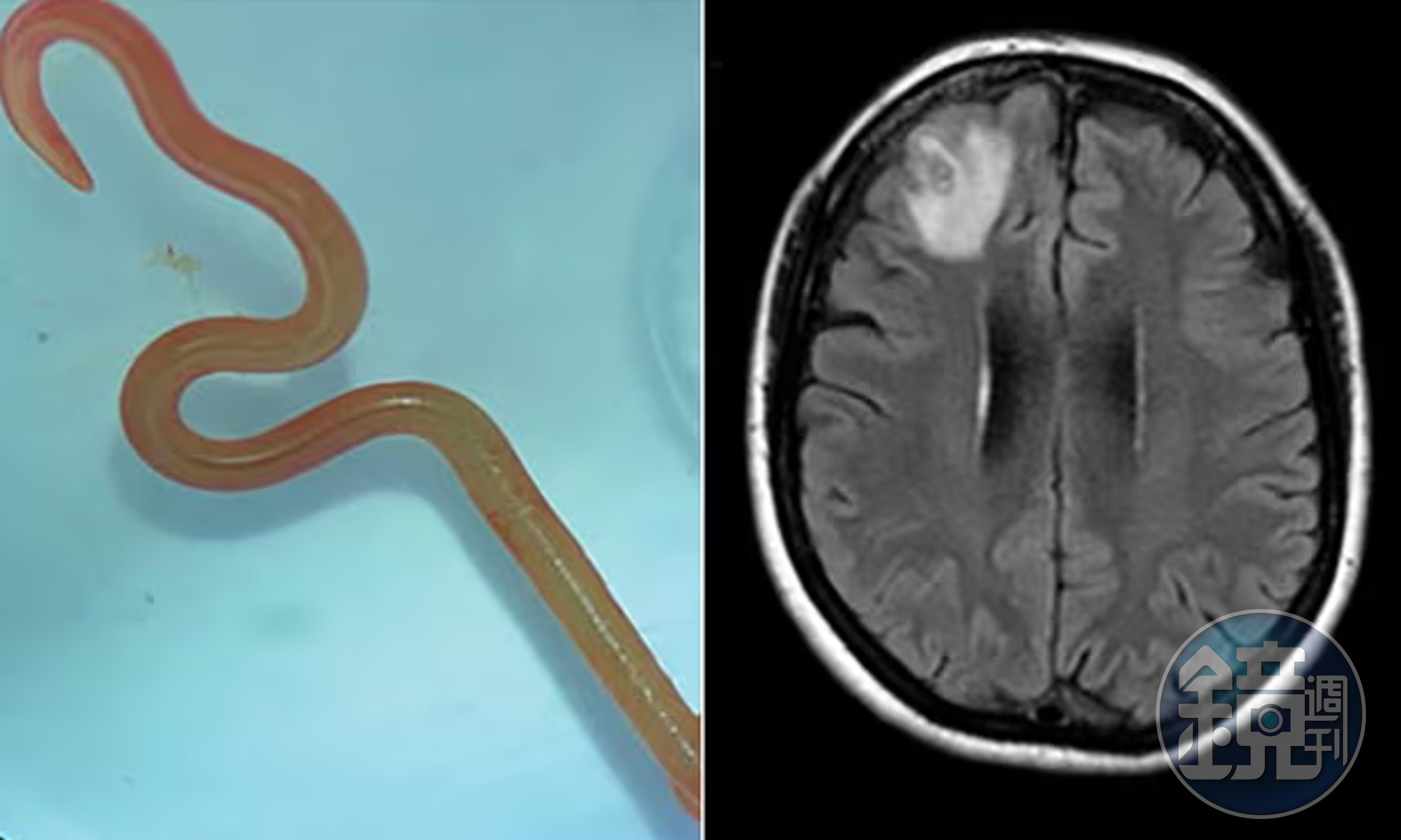 全球首例!8公分蟲蟲在婦女大腦中蠕動噁爆,突健忘、憂鬱症加劇都是因為牠。(翻自《衛報》)