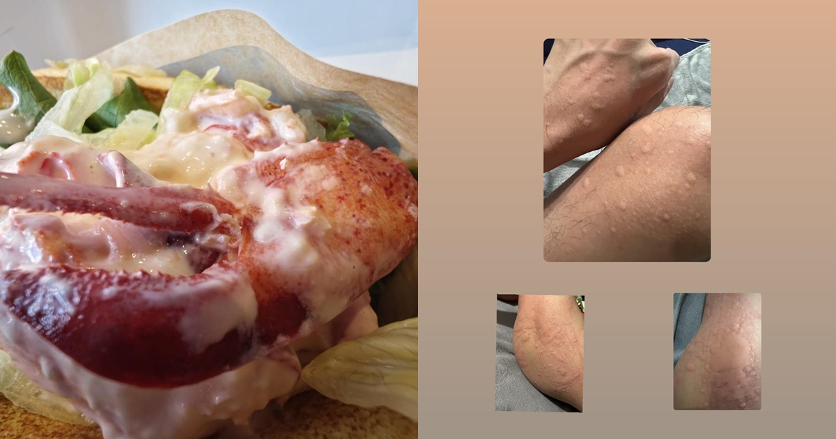 有民眾吃完麥當勞的螯龍蝦堡後嚴重過敏，整個人變成「紅色波羅麵包超人」。（翻攝自PTT、●【爆廢公社二館】●臉書）