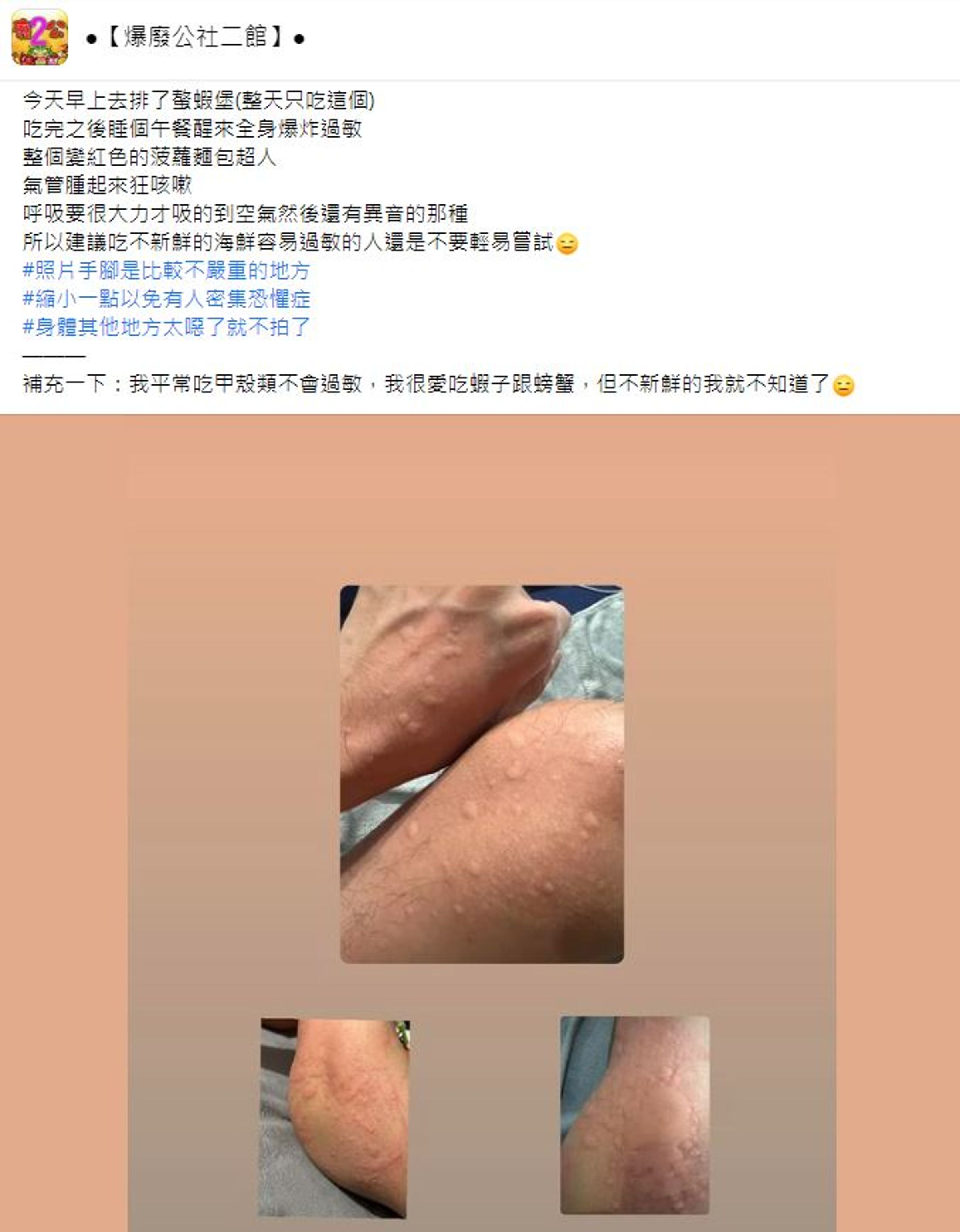 有民眾稱吃了螯龍蝦堡後嚴重過敏。（翻攝自●【爆廢公社二館】●臉書）