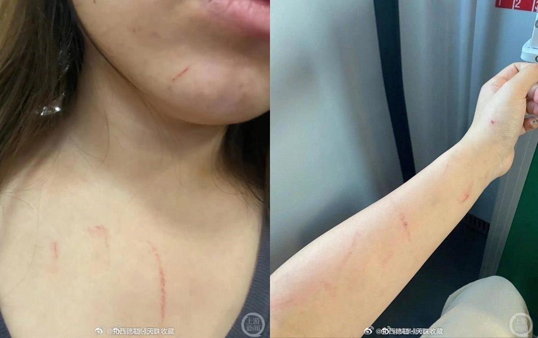 李女因拒絕換位置遭到毆傷，脖子、手部都有明顯抓痕。（翻攝微博）