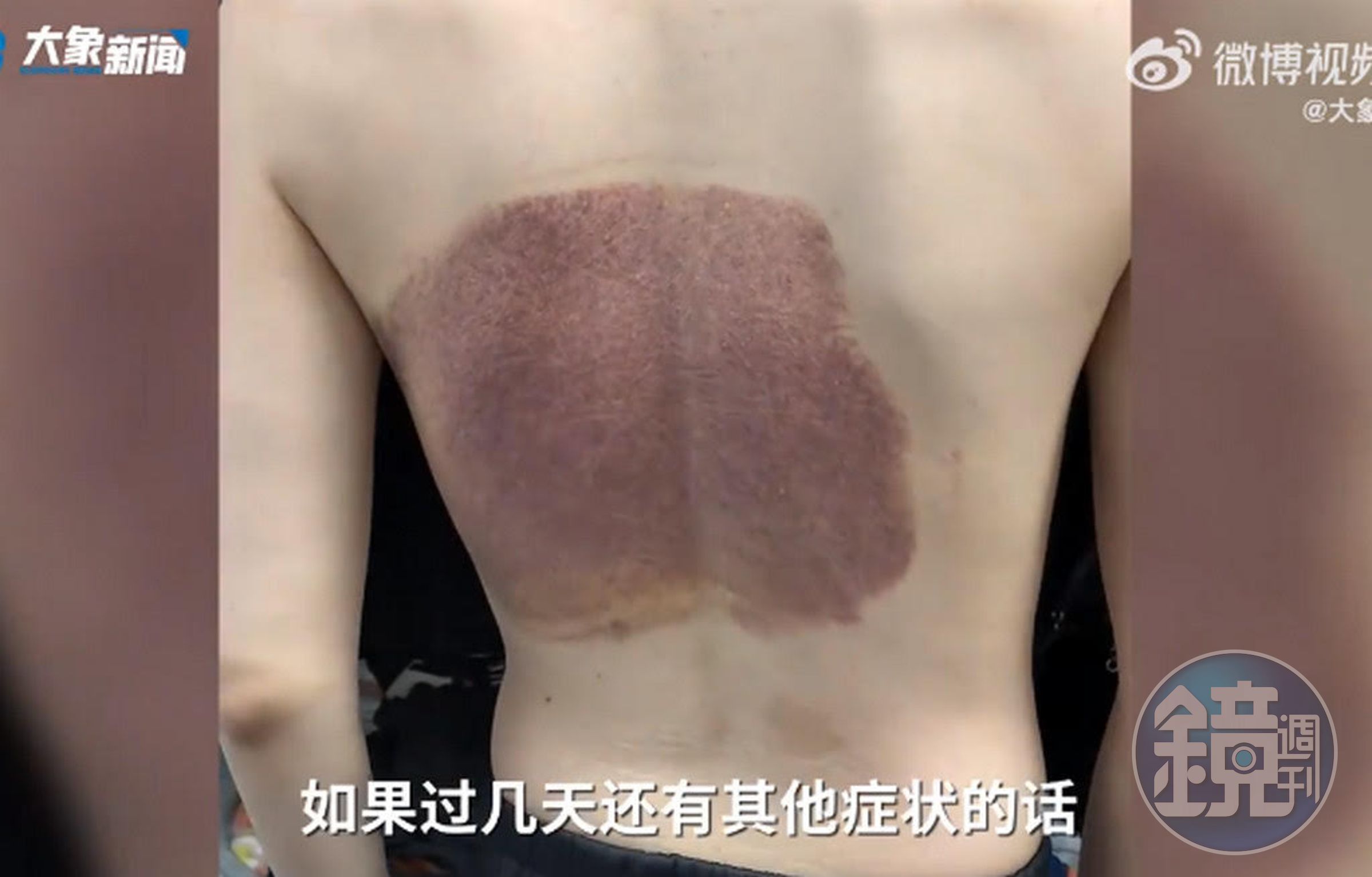 哈爾濱一名男大生在澡堂泡澡被排水口吸住,背部有大片瘀血。(翻攝微博)