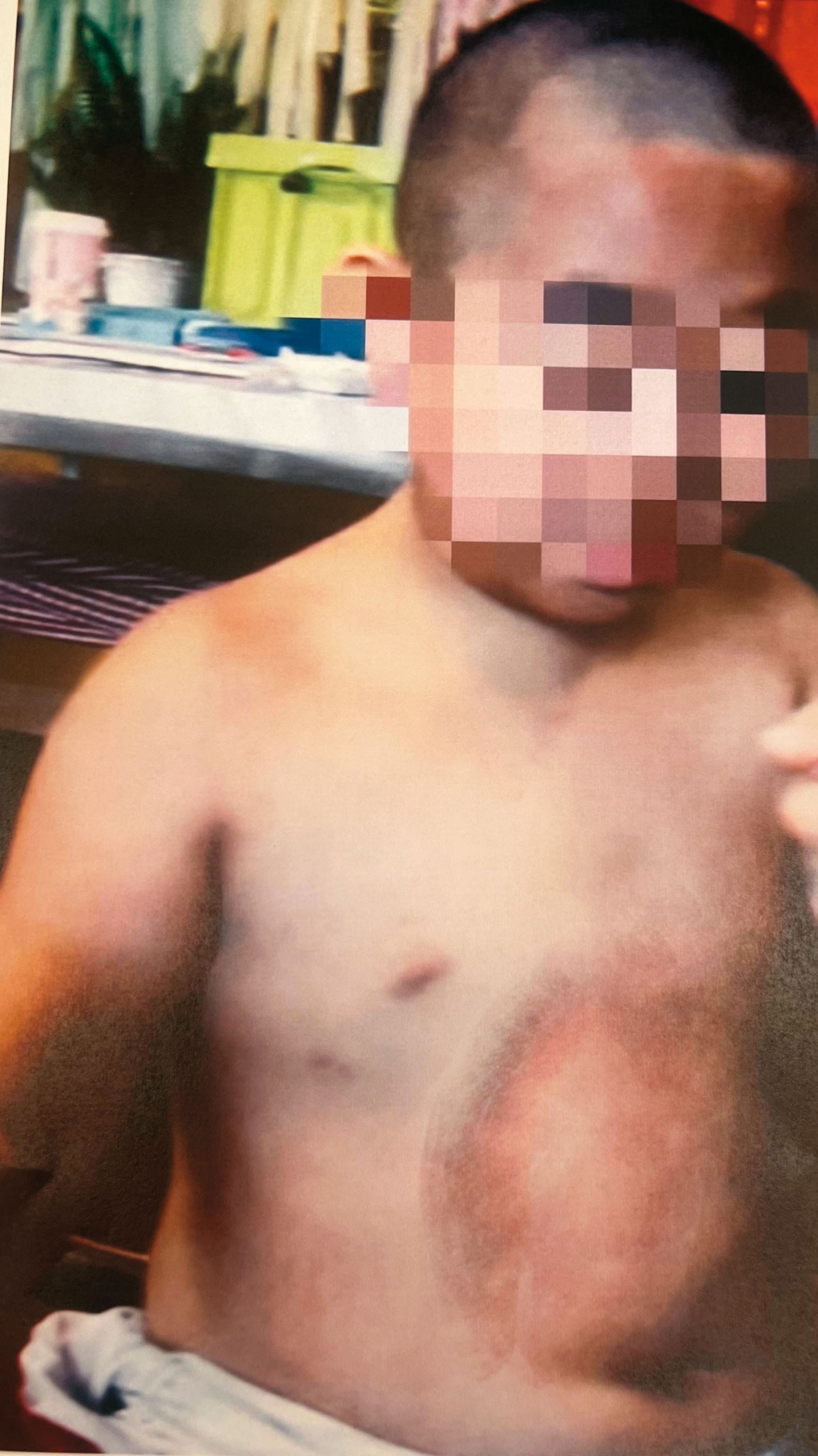 7歲男童小達（化名）遭快艇撞擊，頭、胸、腹部紅腫瘀傷。（讀者提供）