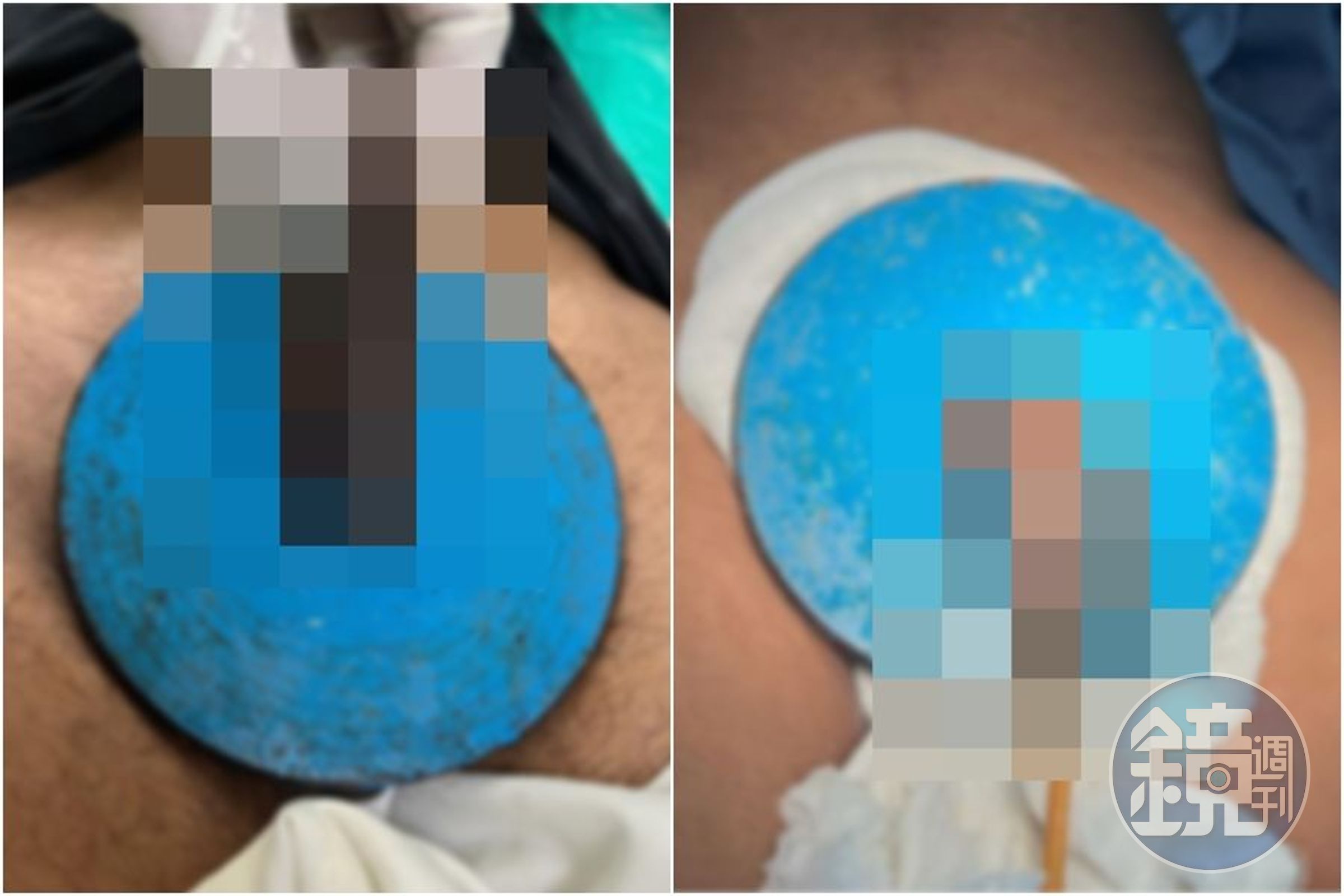 醫師公開男子陰莖腫脹的照片。(翻攝自Urology Case Reports)