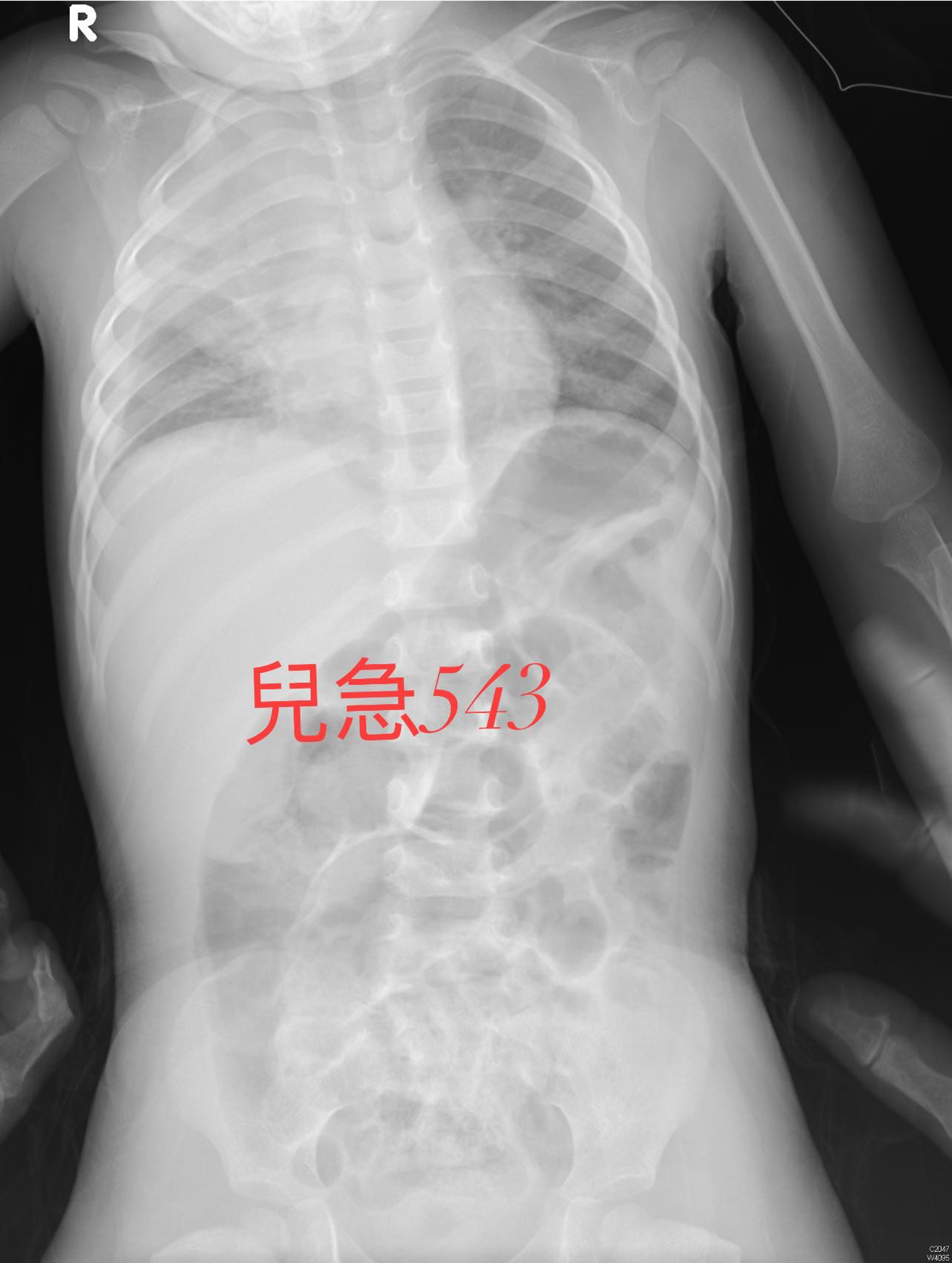 吳昌騰指出許多小孩感染呼吸道融合病毒後,併發肺炎。(翻攝臉書粉專「來講兒科急診的543-吳昌騰醫師」)