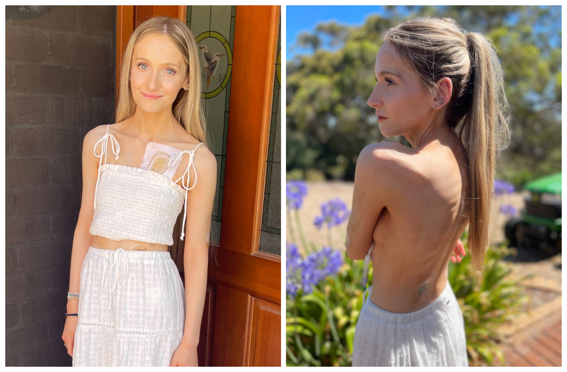 霍蘭胸口持續接著營養與醫療管線，背部因長期疾病與骨折變形，她仍堅強面對。（翻攝annaliese_holland IG）