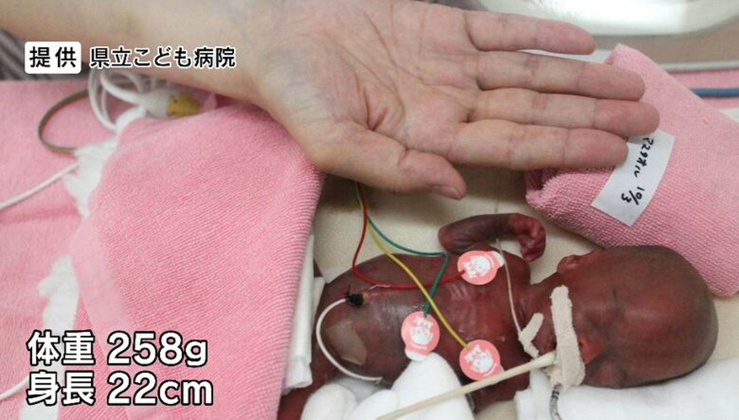 關野龍佑出生時僅258克,比成人手掌還小。(翻攝X@FNN_News)