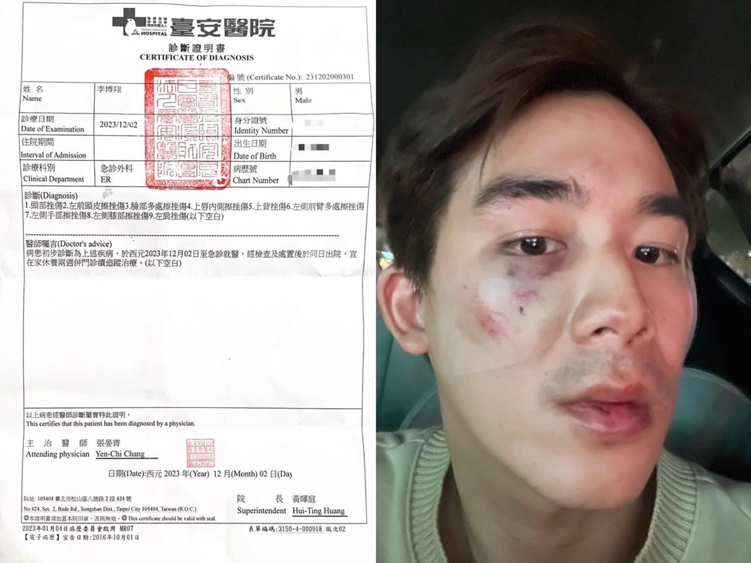 藝人李博翔街邊遭毆打，臉部傷勢不輕。（翻攝李博翔臉書）