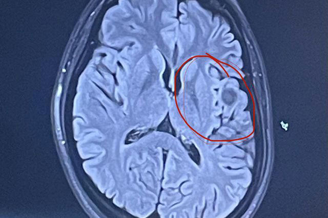 杜蘭多大腦中有一團血管糾結，醫學上稱為「海綿狀血管瘤」。（翻攝people.com）
