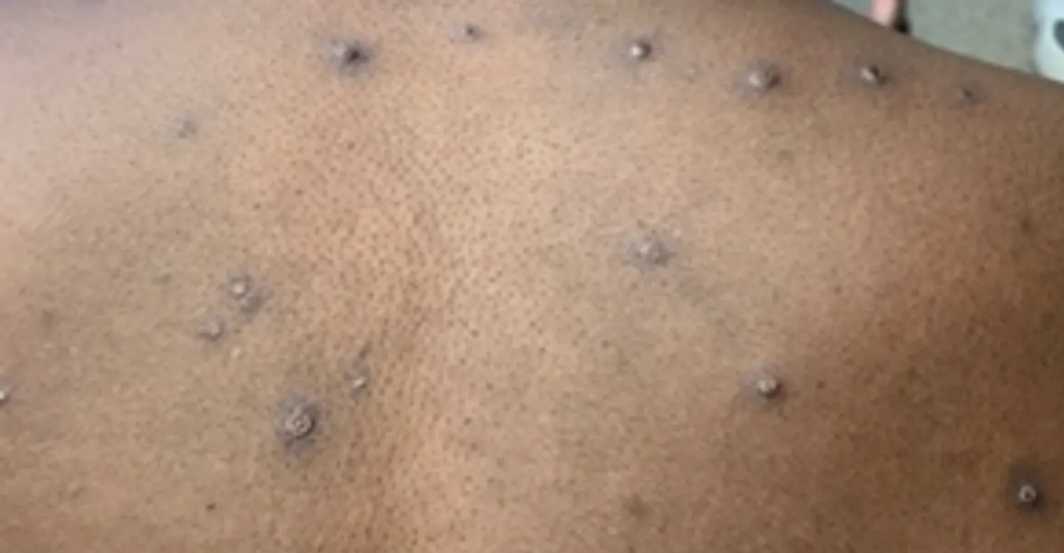 全球M痘疫情持續升溫，其中非洲區自5月起疫情更是明顯上升。（翻攝自美國CDC官網）