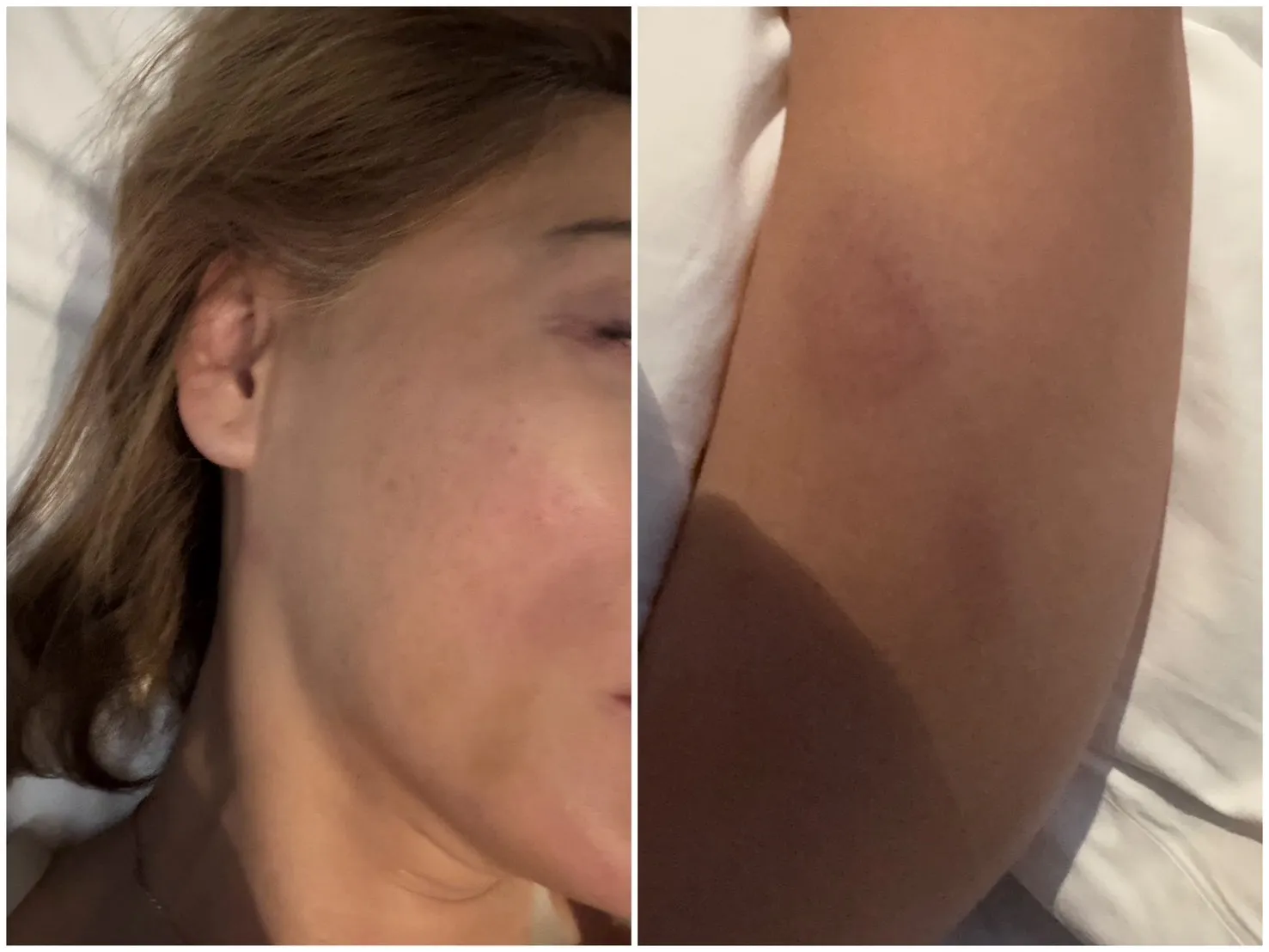 李沛綾遭前夫暴打後臉上明顯紅腫，以及手部多處瘀青。本人提供