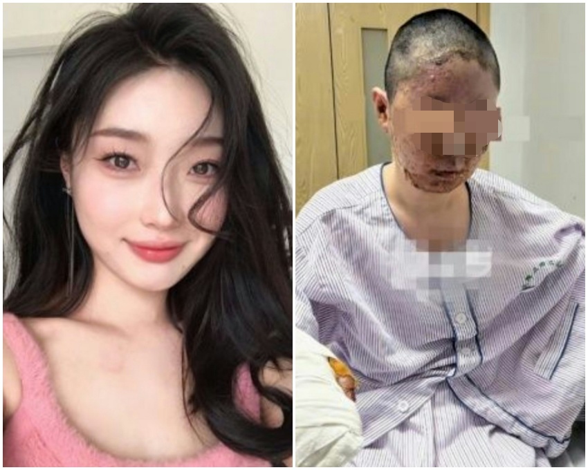 中國美妝網紅童瑤因家中發生瓦斯氣爆，導致身體大面積燒傷。（翻攝微博）