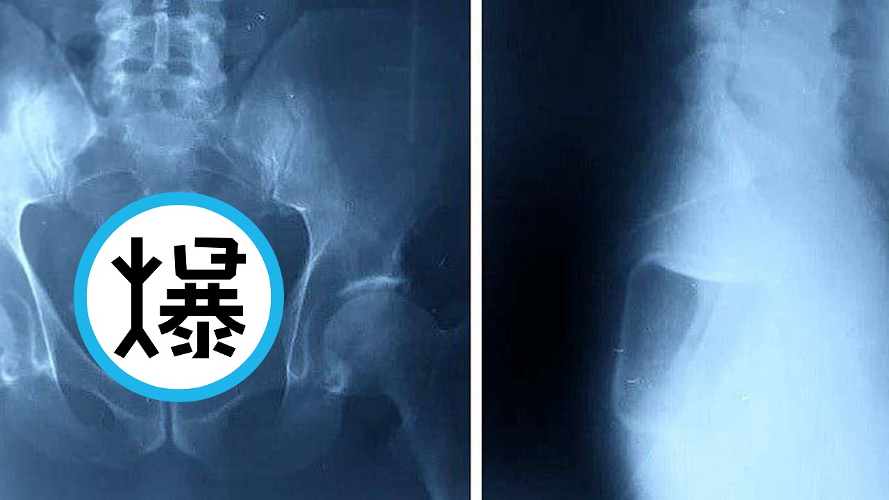 性愛玩過頭，下體被玻璃罐與保險套塞滿！醫警告「玻璃心碎」就沒命了。（翻自X平台）