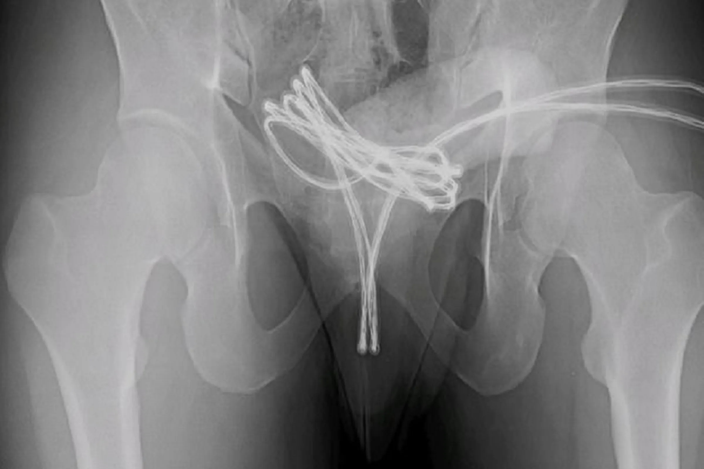 與USB線刺激愛愛，整條卡進下體突破膀胱！尷尬影像曝光。圖／翻自《Cureus》