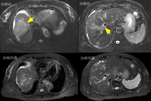 七旬婦人肝癌指數破表，經雙免疫療法治療4週後肝癌指數落至正常值20以下，腫瘤明顯縮小，至今病情控制良好回復正常生活。（台灣肝癌醫學會提供）