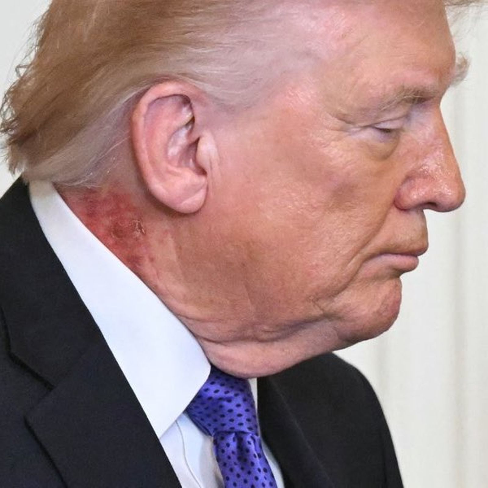 川普的私人醫師解釋，他正在使用一款「預防性皮膚藥膏」，導致頸部出現泛紅現象。（翻攝X@buffys）