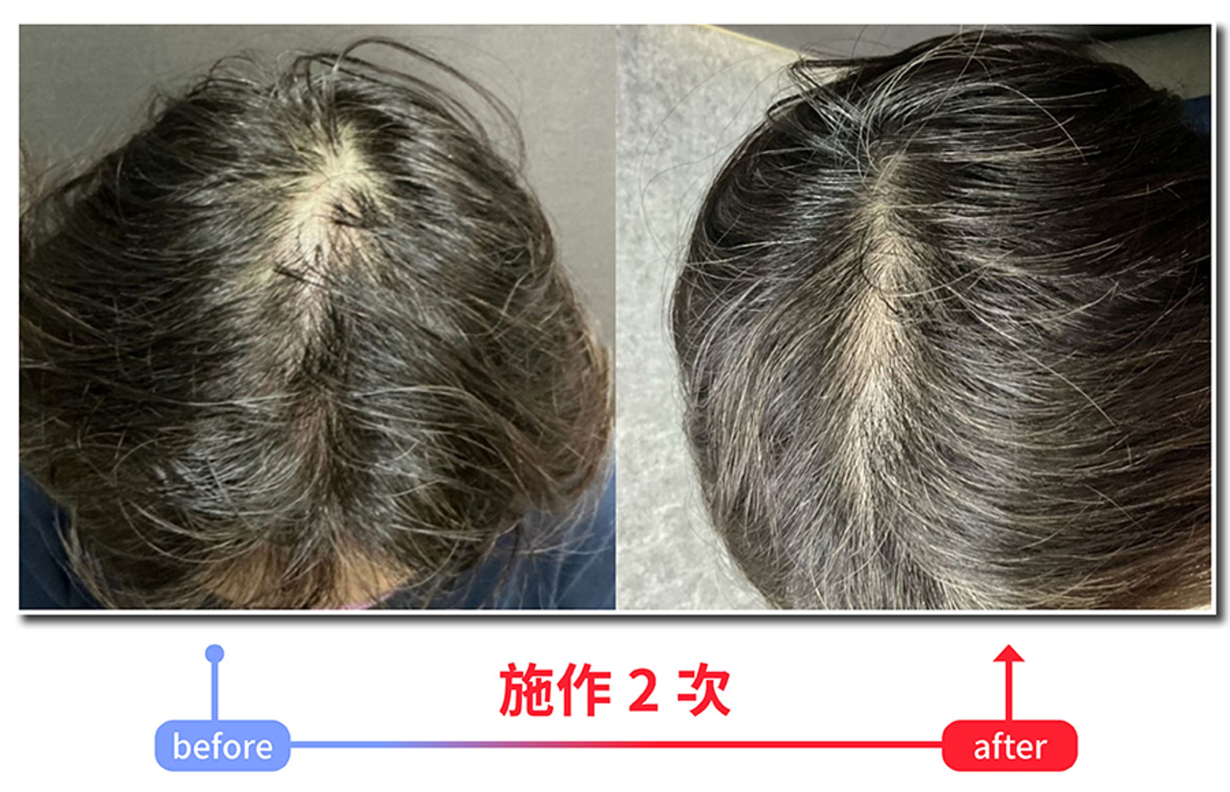 圖為產後掉髮案例經過愛爾麗頭皮管理療程僅施作2次,就能肉眼看見髮量改善,稀疏處逐漸回復濃密。