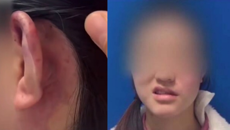 中國社群近年興起「精靈耳」醫美熱潮，宣稱能透過注射讓耳朵挺立、顯臉小，卻導致多起術後併發症與毀容案例。（翻攝自微博）