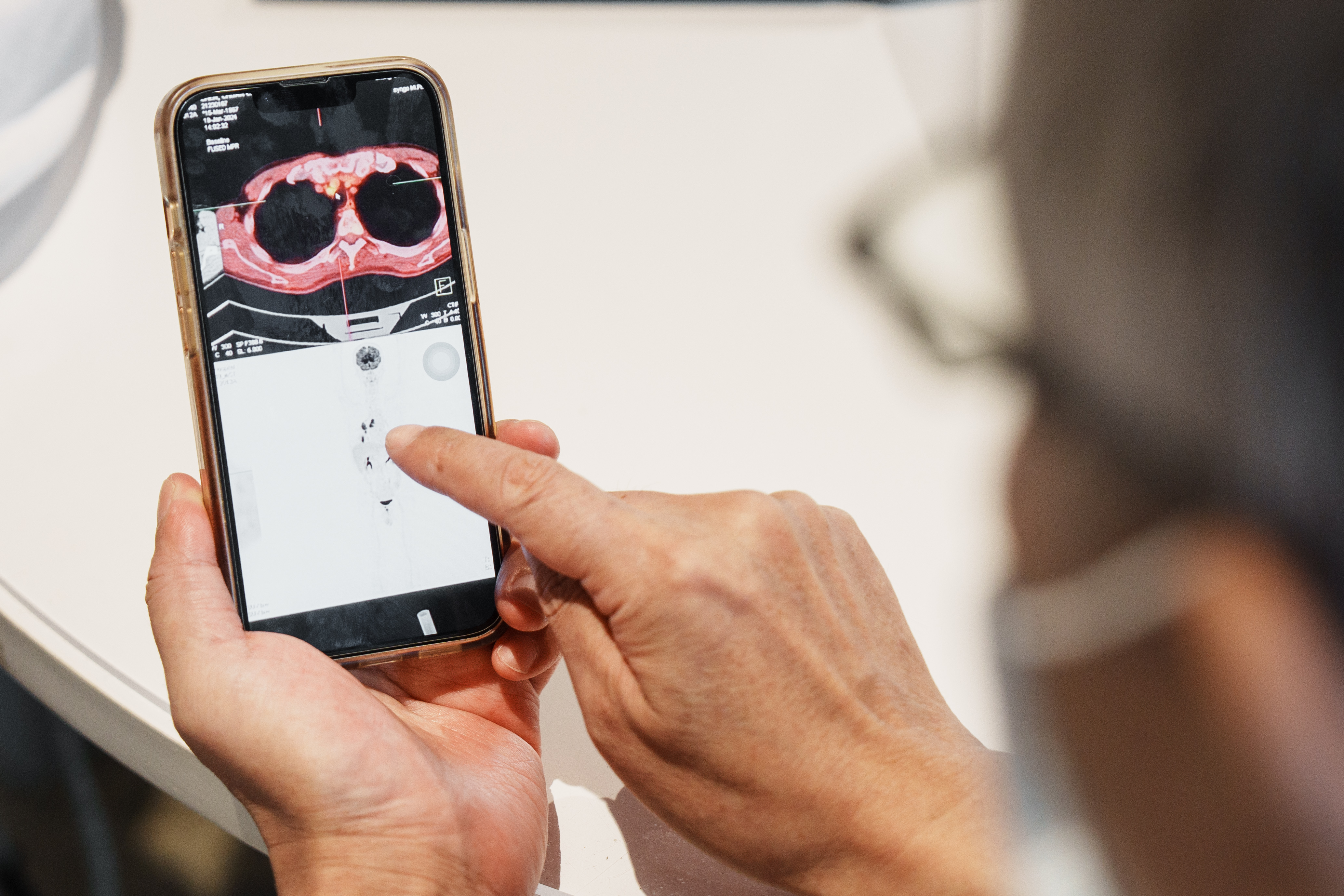 晚期肺腺癌中，約4成的患者沒有腫瘤基因突變，由於健保的免疫藥物給付嚴苛，絕大多數病人仍停留在傳統化療，但預後不佳。