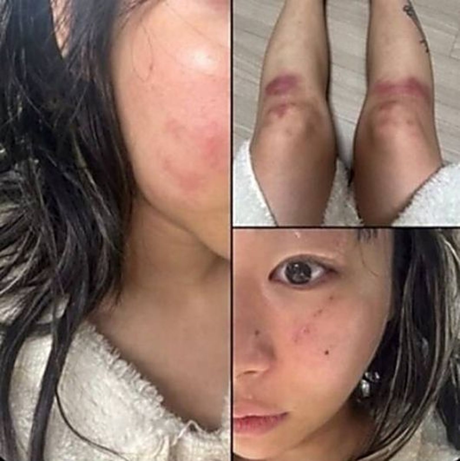 Jvcki Wai曬出被打得鼻青臉腫的照片。（網路圖片）