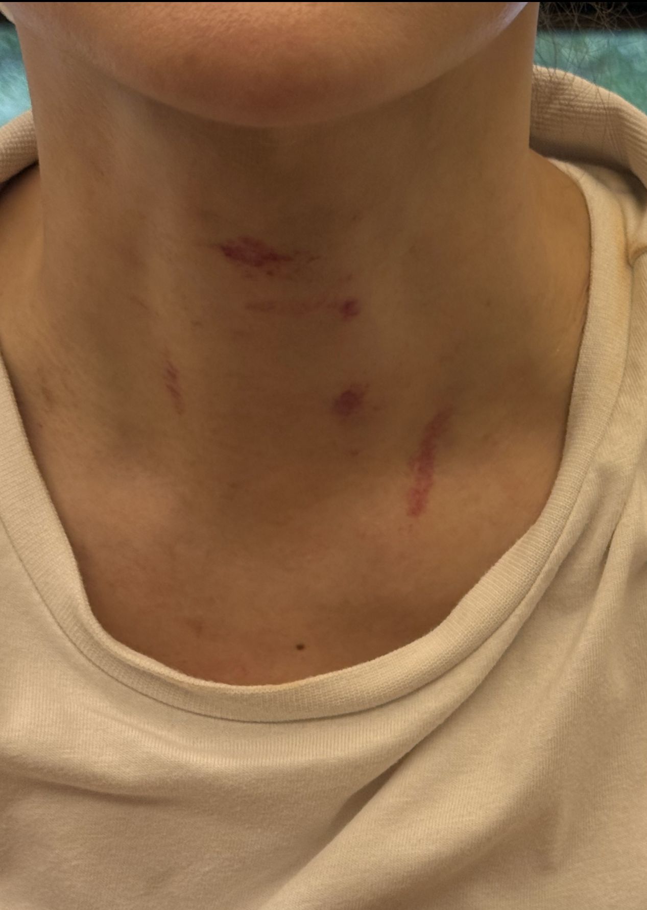 李沛綾兩個月前也曾遭前夫掐頸，脖子血痕清晰可見。本人提供